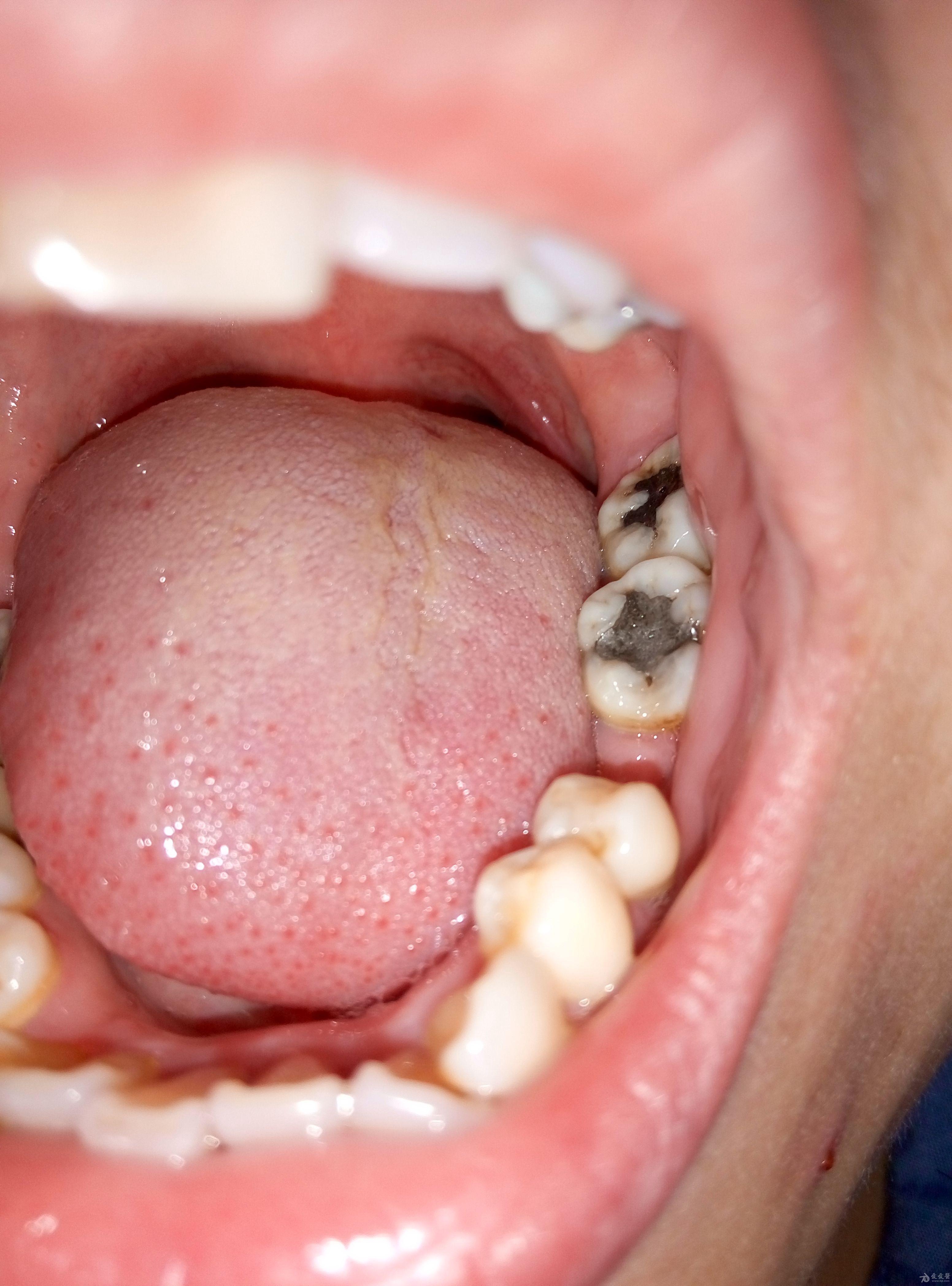 汞中毒牙齿图片图片