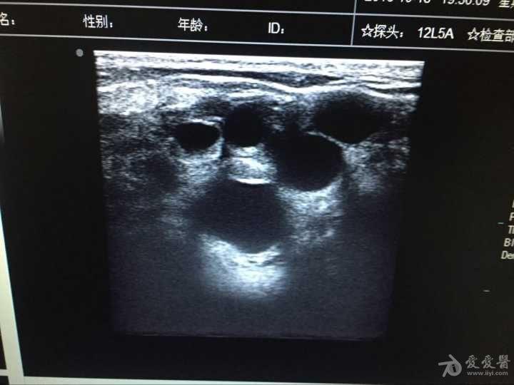 典型乳腺囊性增生 - 超声医学讨论版 - 爱爱医医学论坛