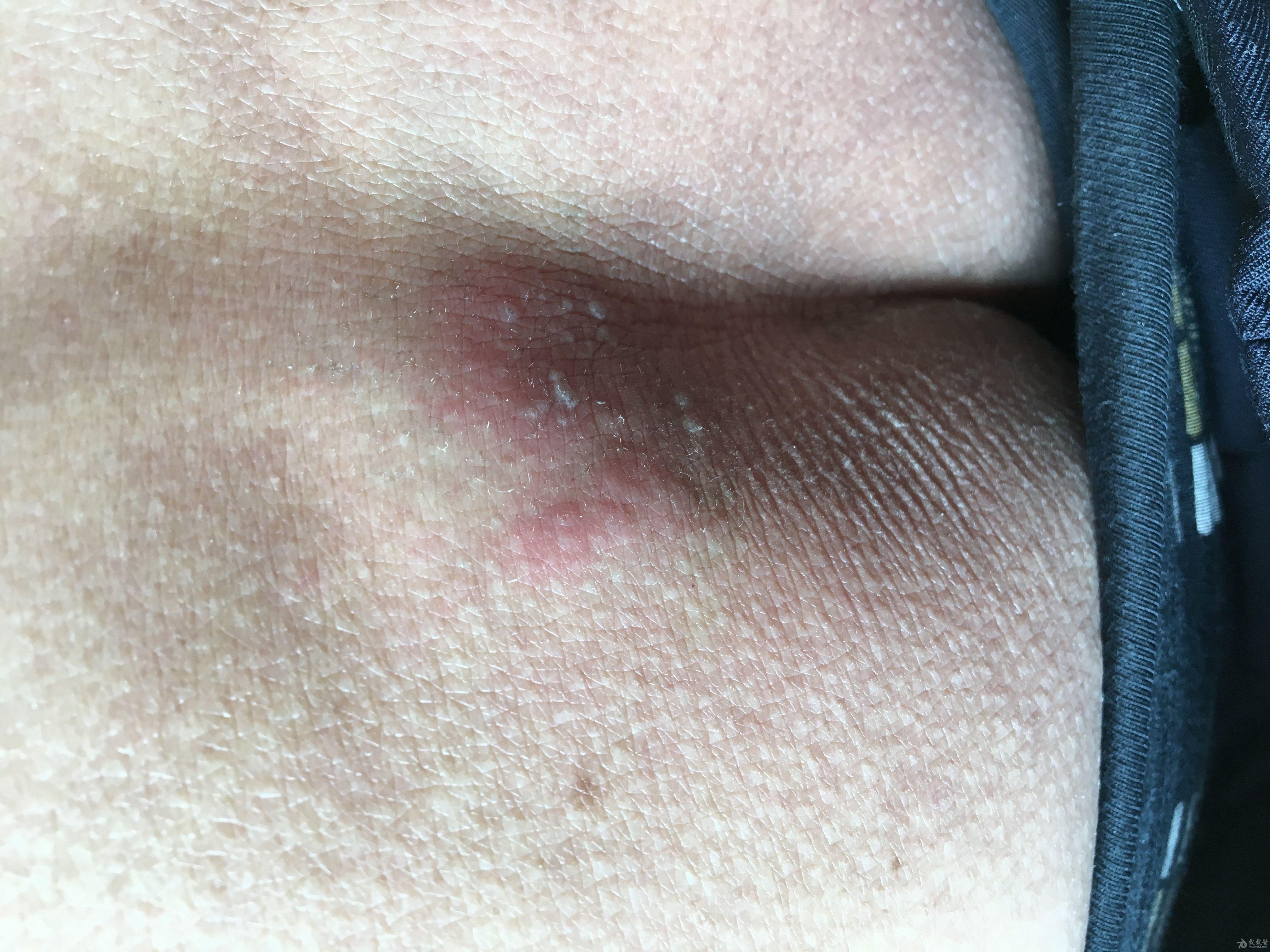 左侧腰胝部疼痛3天皮疹1天