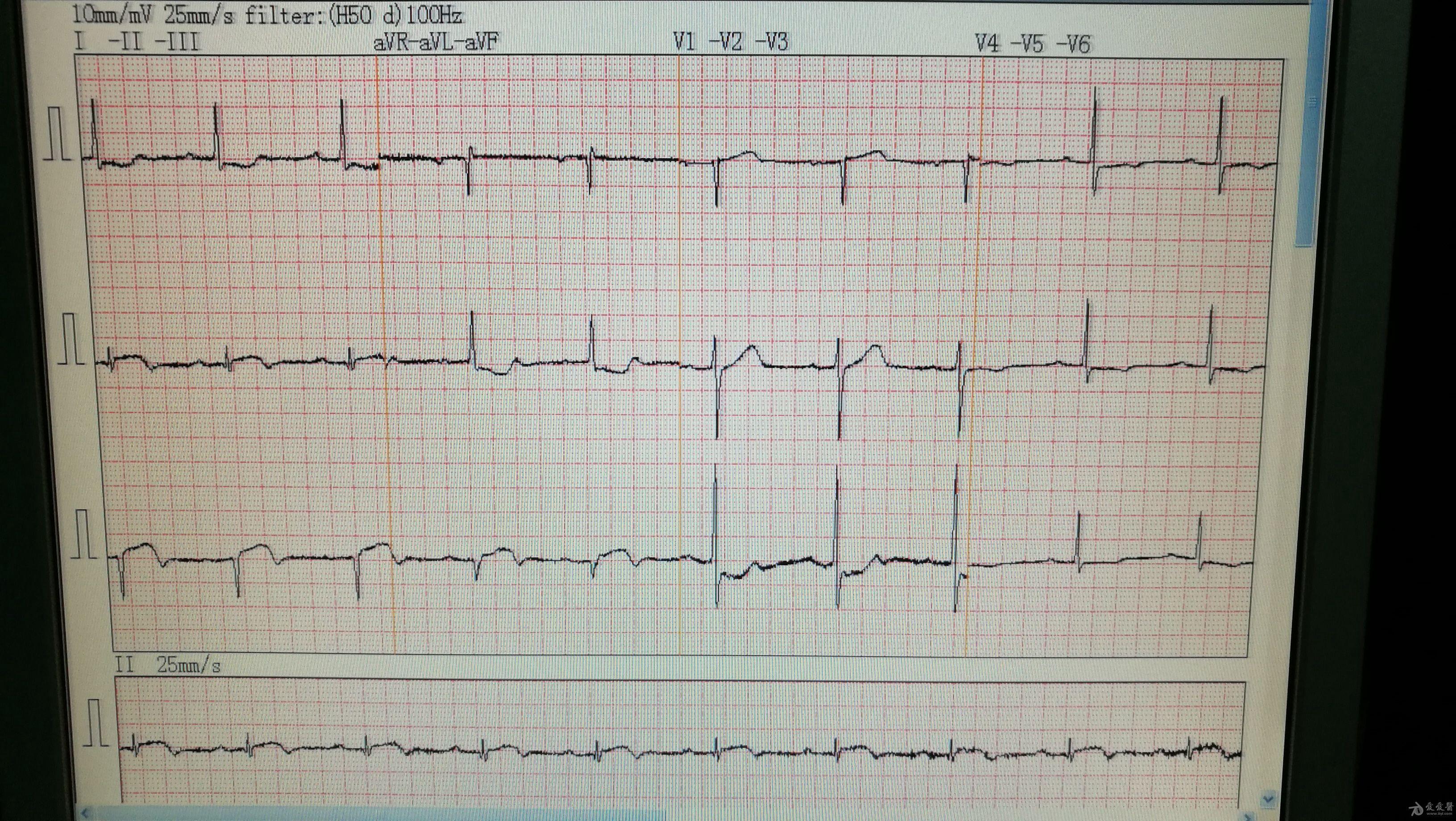 心电图脑电图专业讨论版 - 爱爱医医学论坛