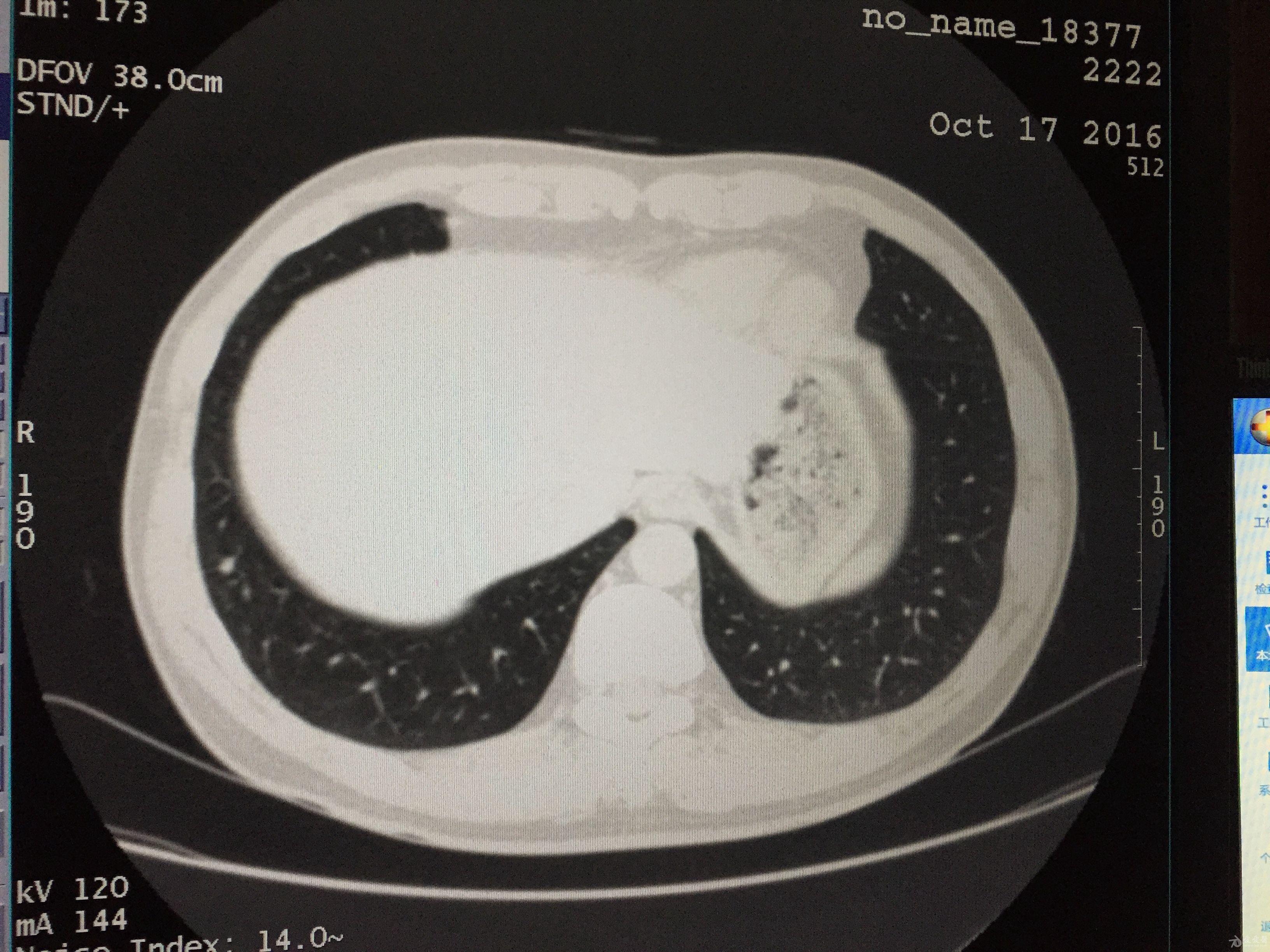 肺部阴影诊断图片