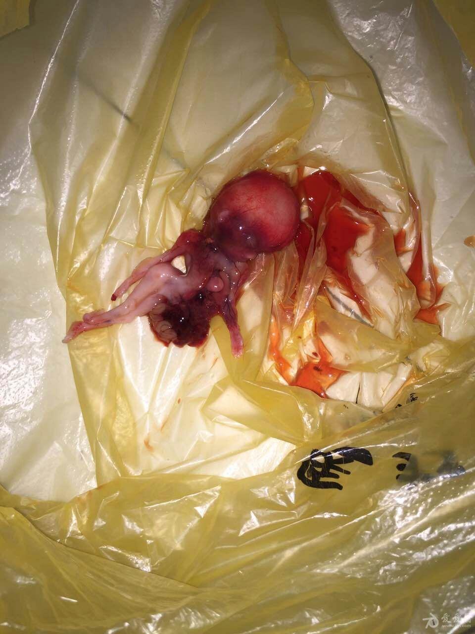 停经136周彩超检查提示胎儿先天性腹裂心脏外移一例