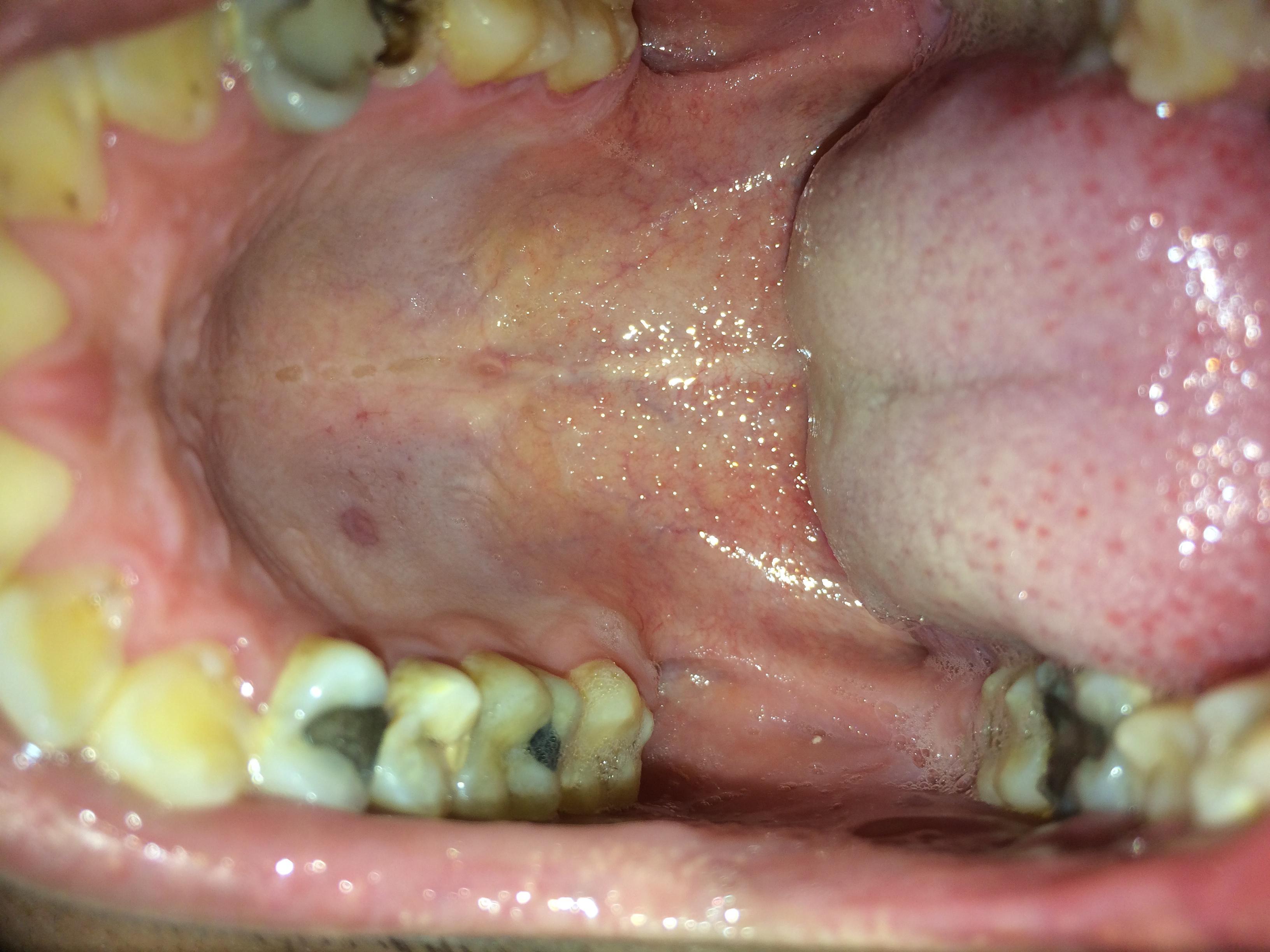 口腔上颚腺瘤图片图片