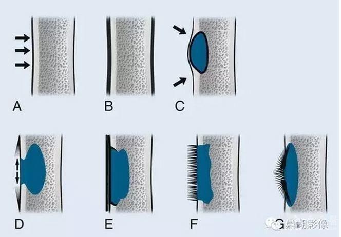 骨膜反应图片图片