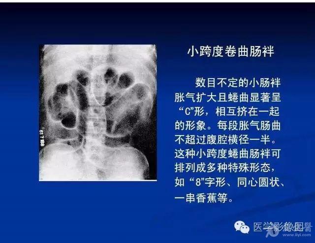 最全肠梗阻的分类及影像学表现要点解读