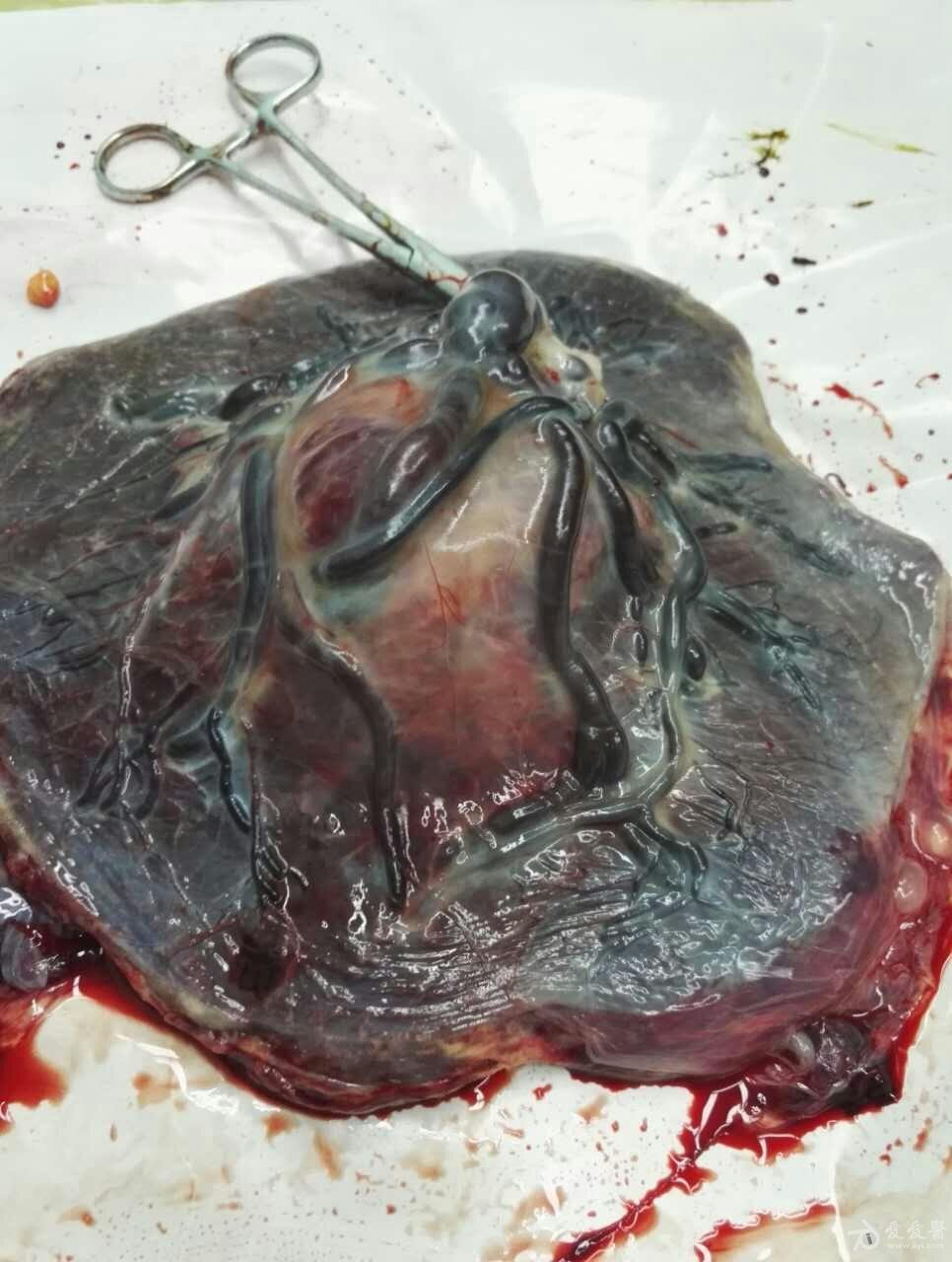 产科胎盘血管瘤照片