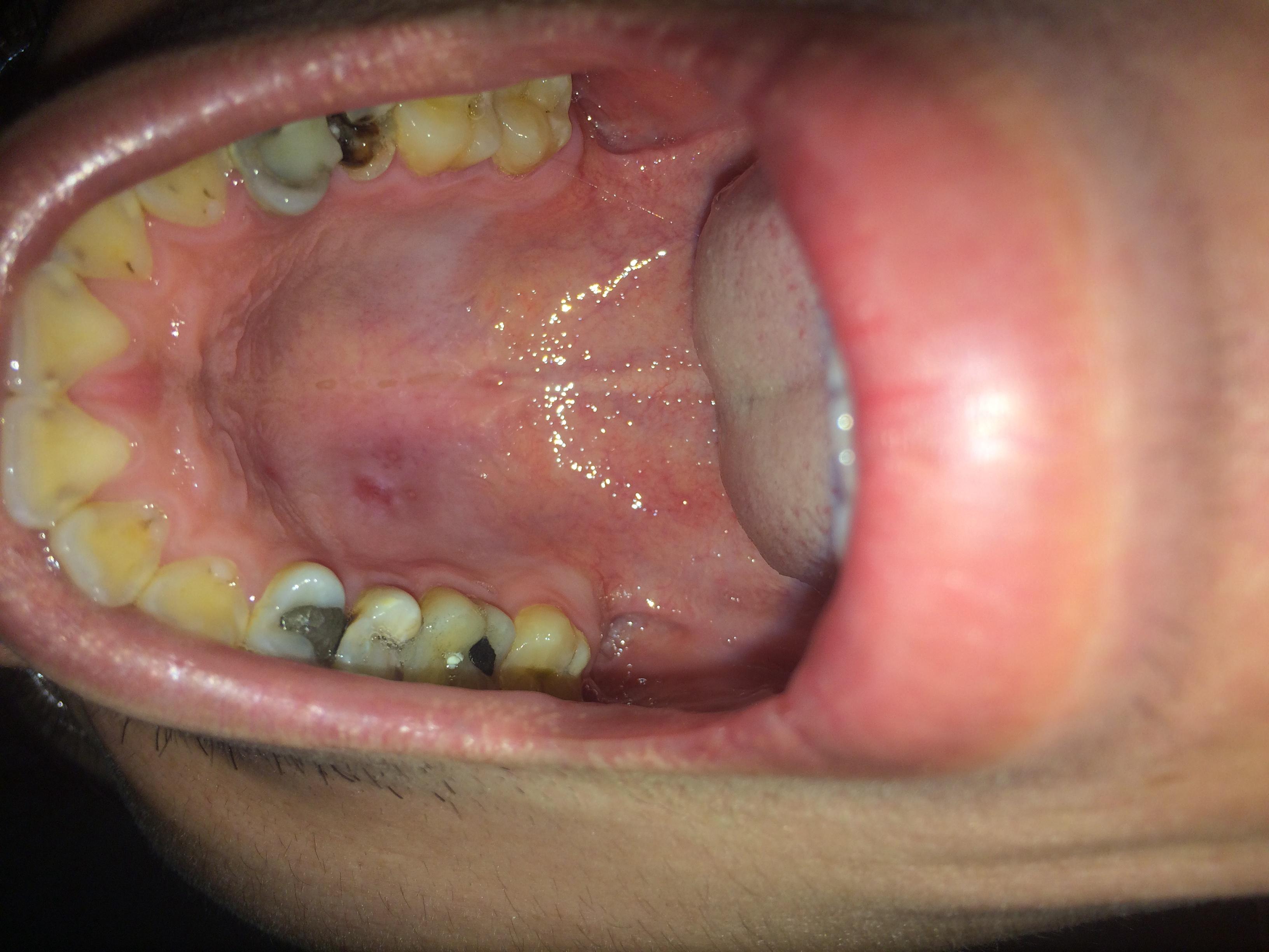 口腔下颚有个凸起异物图片