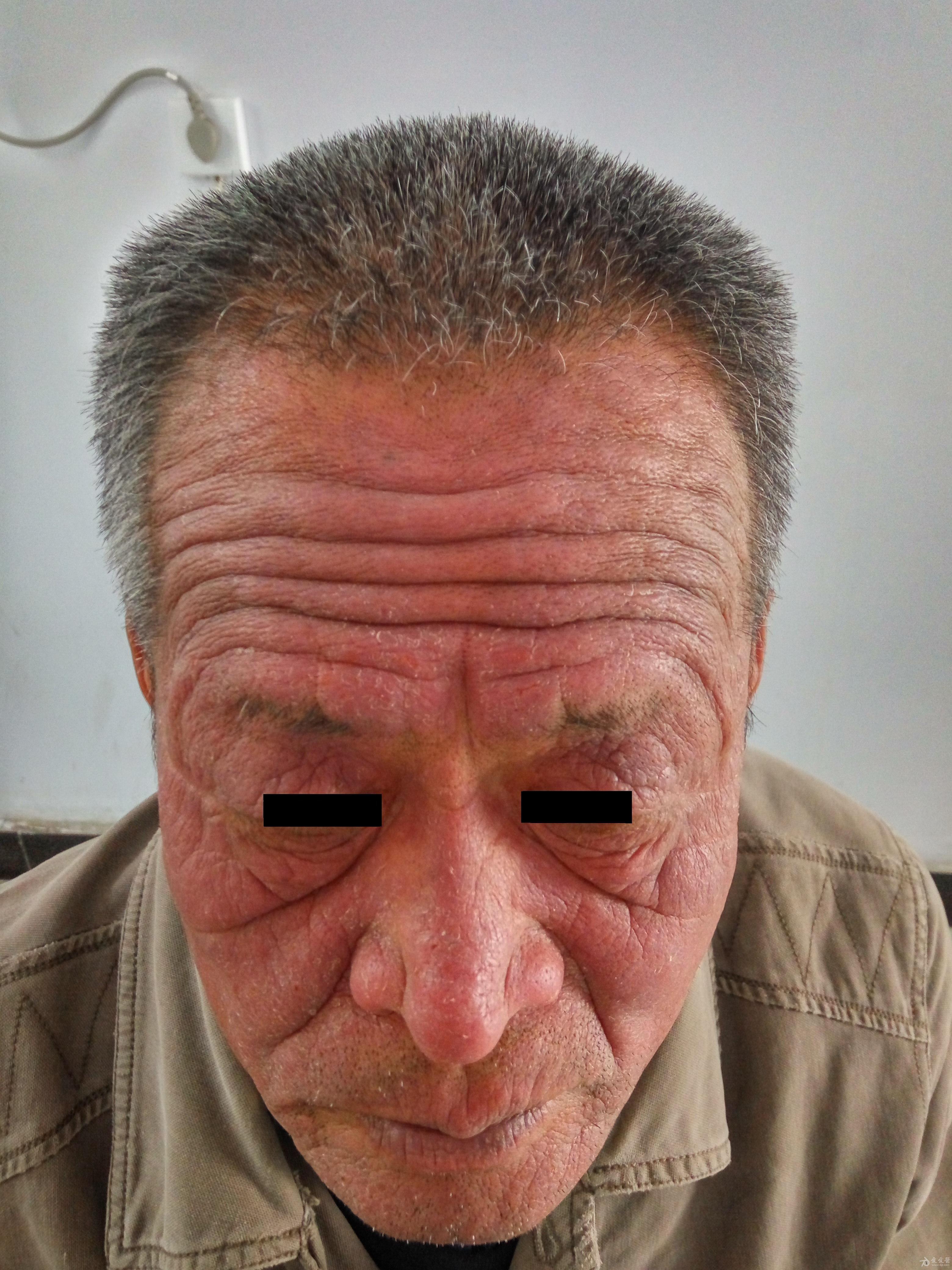 慢性光化性皮炎一例讨论(经大家会诊:慢性光化性皮炎-良版11.11)