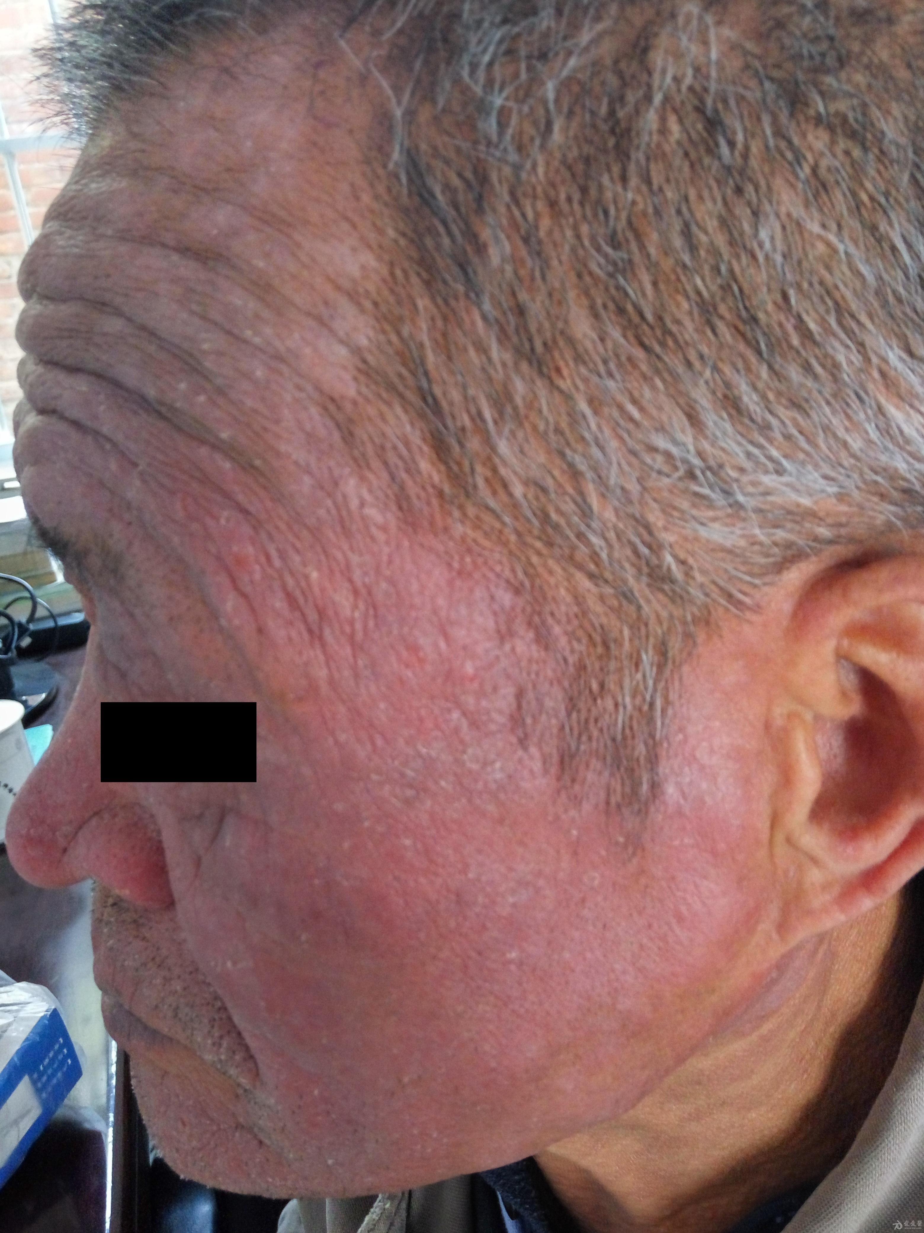 慢性光化性皮炎一例讨论(经大家会诊:慢性光化性皮炎-良版11.11)