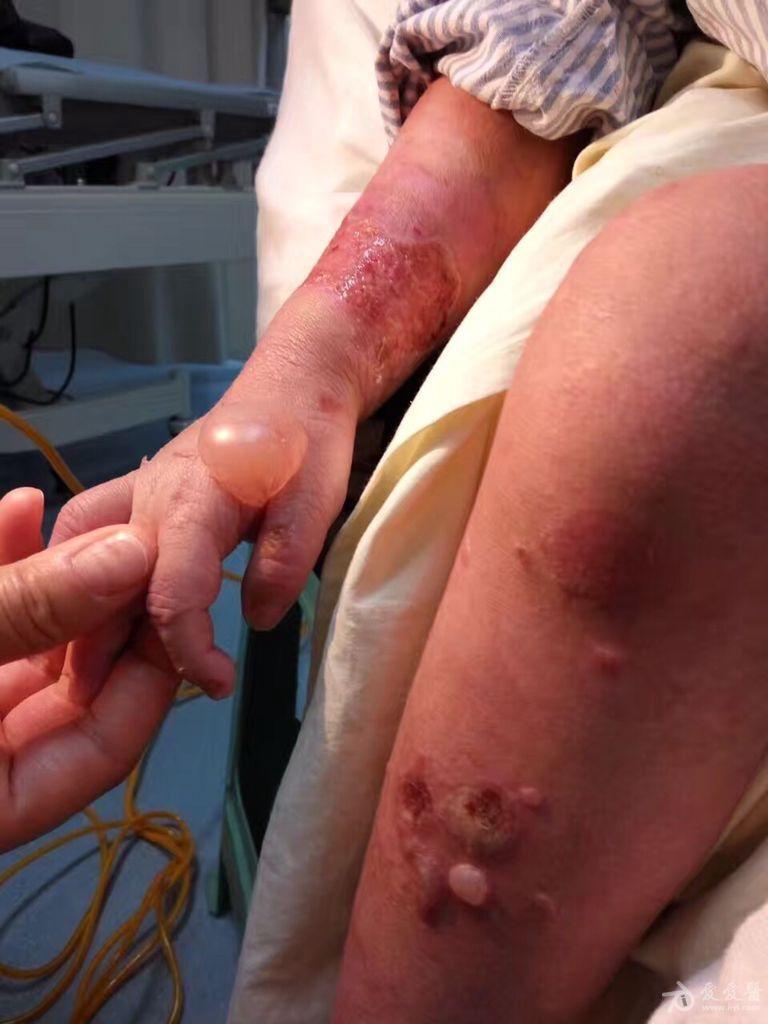 天疱疮康复病例