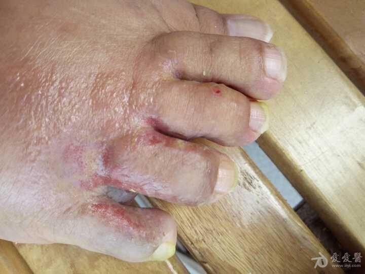 看图诊断足癣并感染