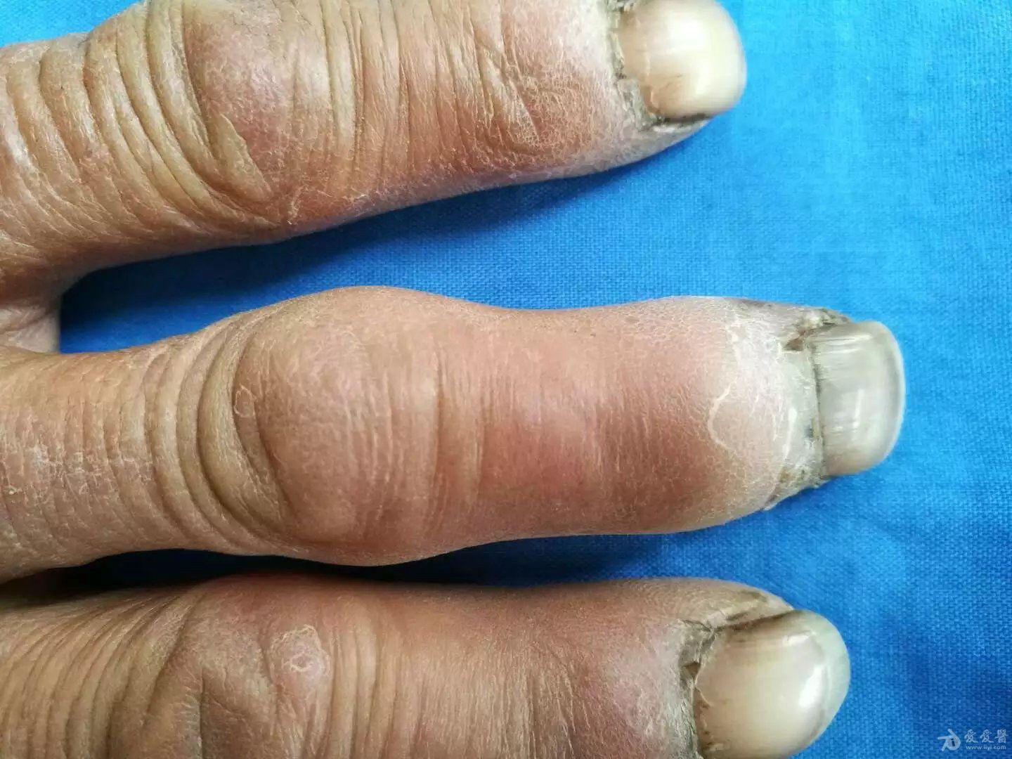 2016年皮肤版有奖病例猜答(21)答案:闭塞性动脉硬化症.