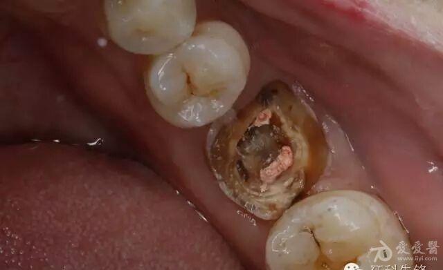 残根的挽留氧化锆还是铸瓷的选择转