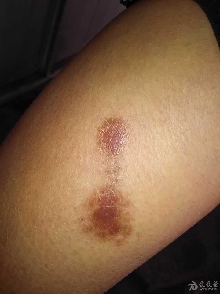 想拟皮肤病有奖猜图5金黄色苔藓