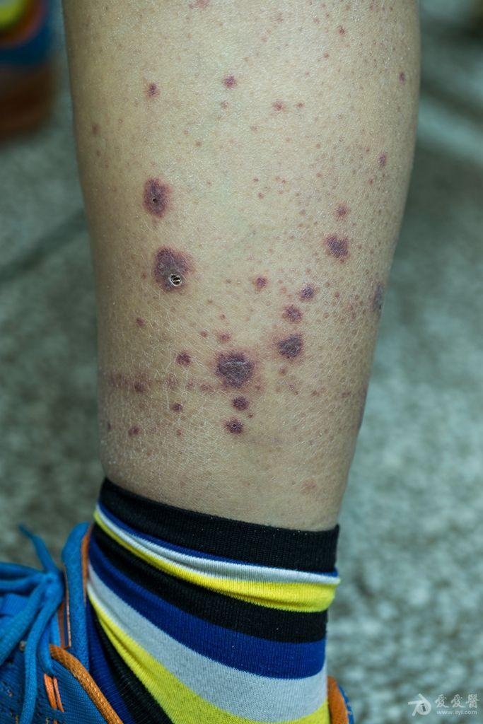 紫红色斑片斑点分布于两下肢,紫癜皮疹一例 