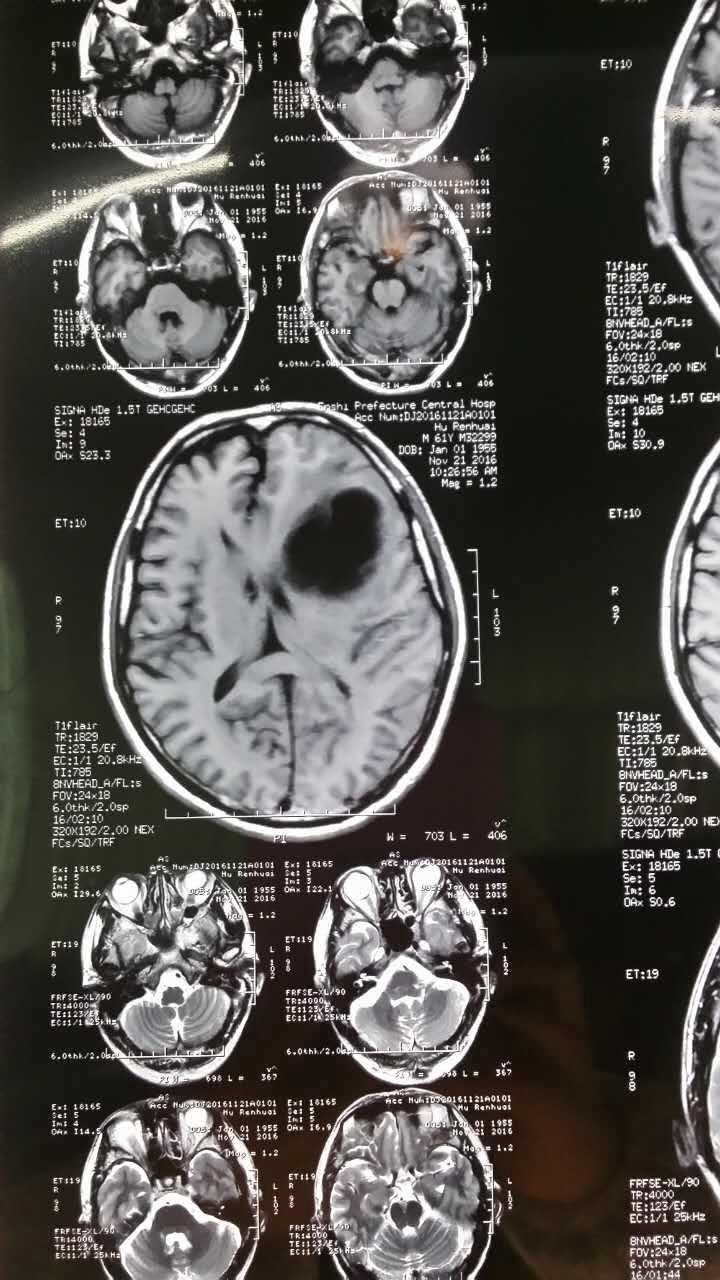 请医生看看头颅磁共振片子
