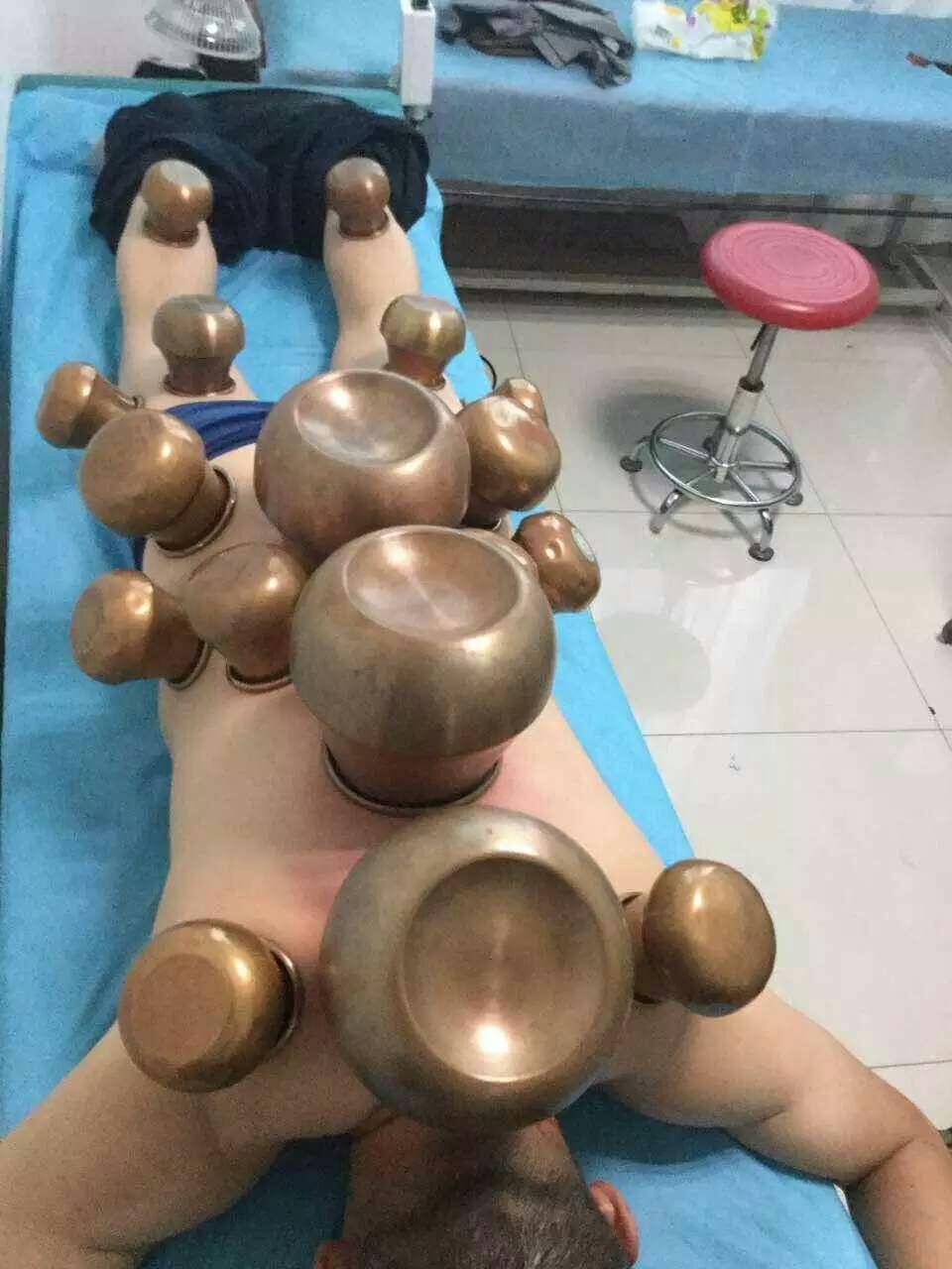 铜火罐和玻璃罐的比较