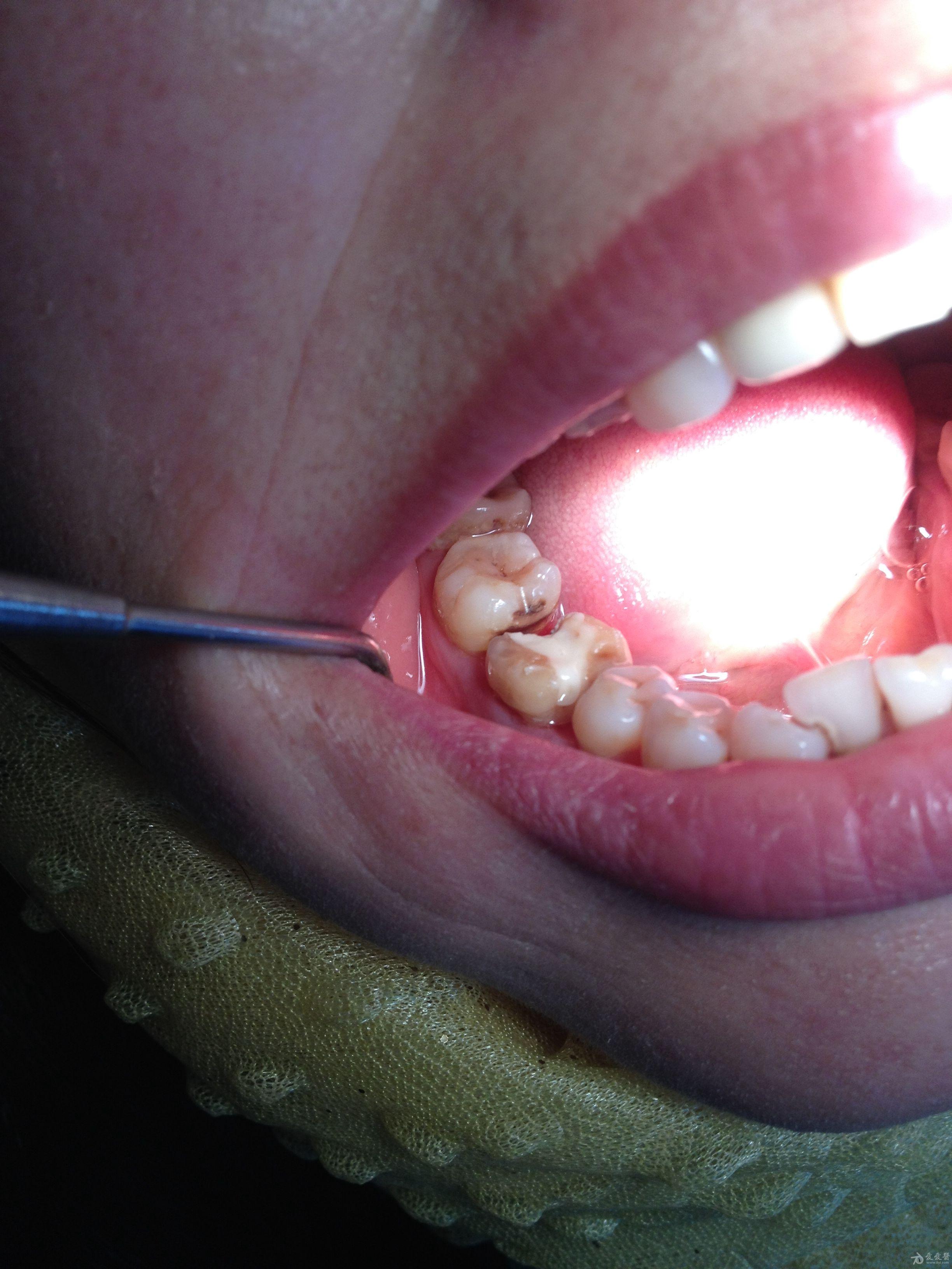 牙隐裂导致牙纵裂后修复成功一例