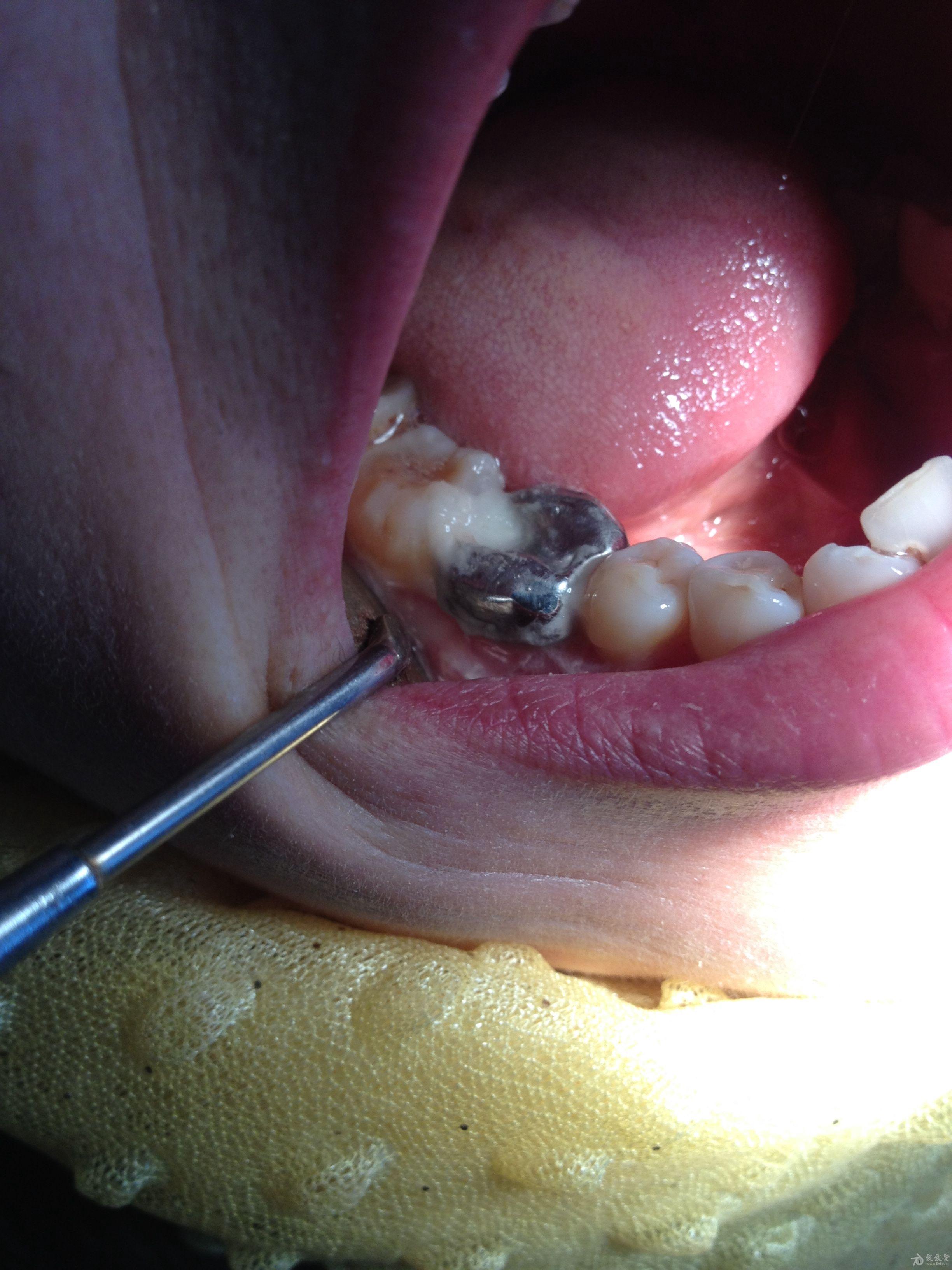 牙槽嵴裂图片