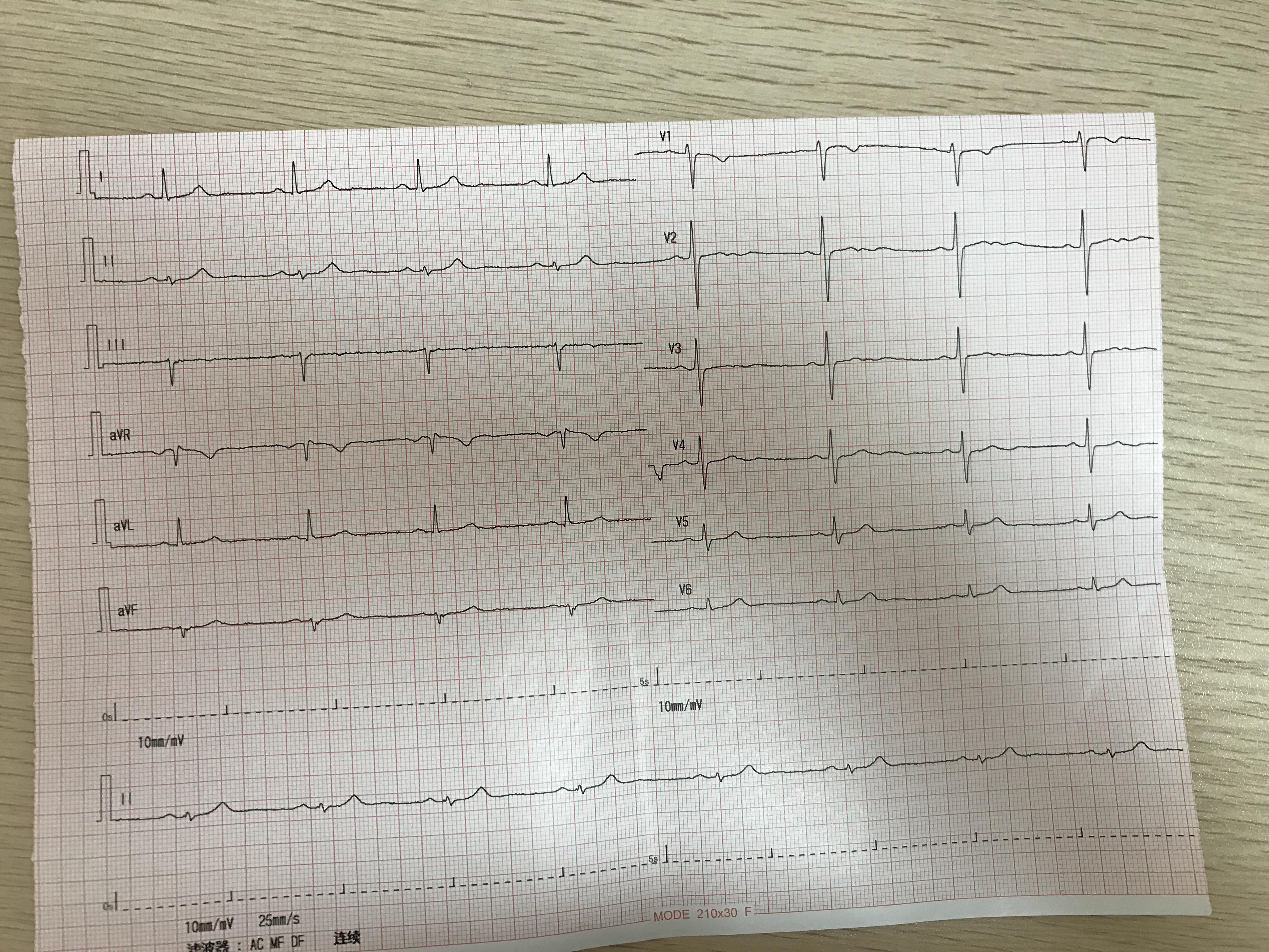 心电图avf图片