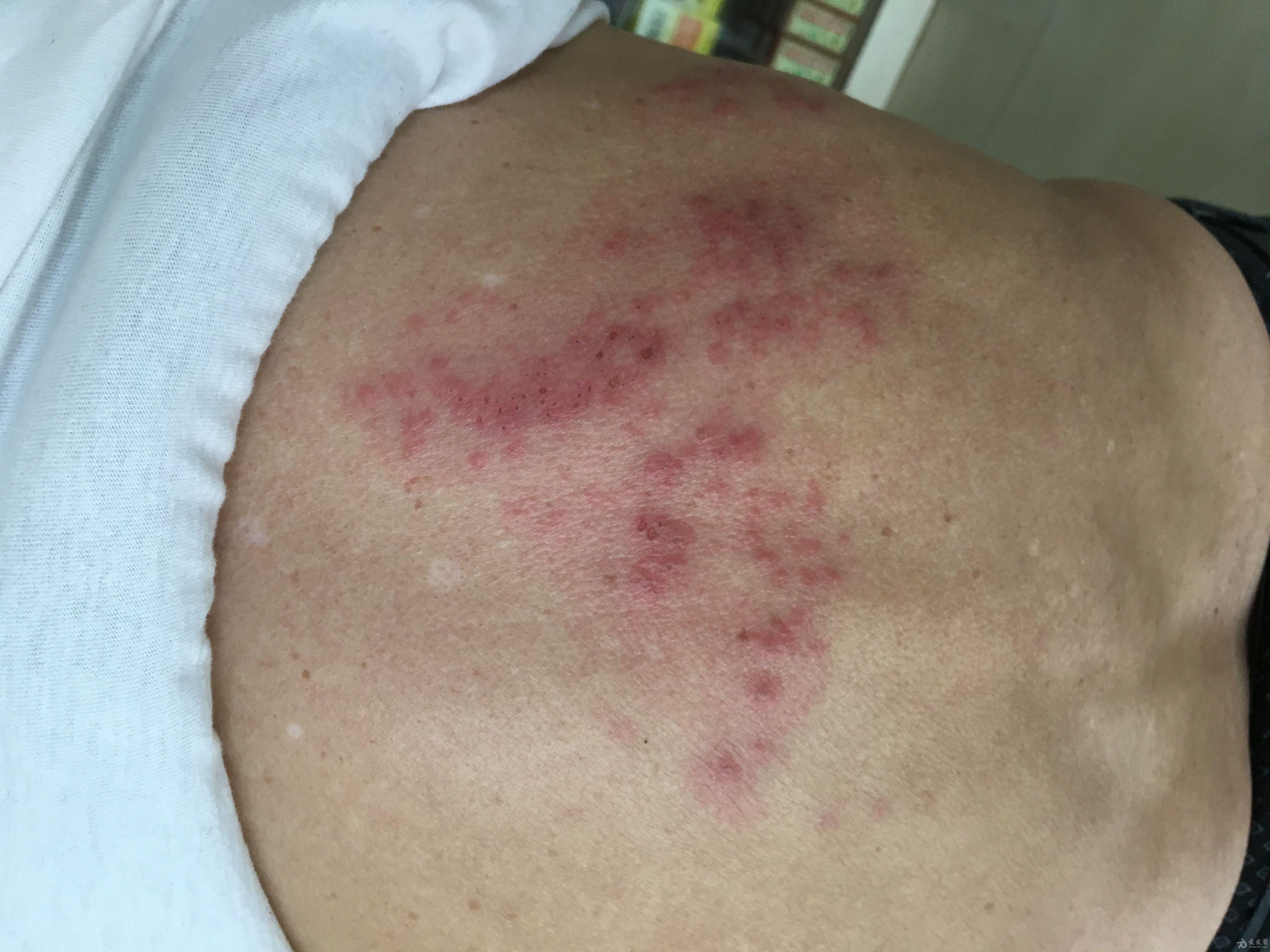右胸背部疼痛5天皮疹2天(原创)