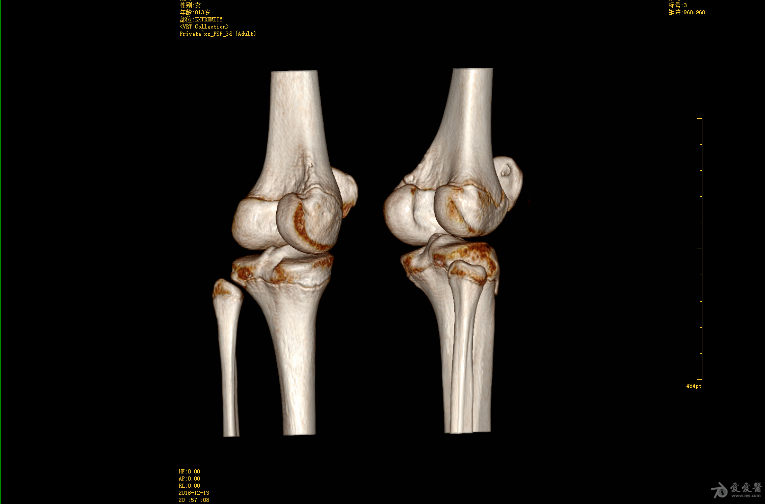 膝关节ct三维重建图片图片