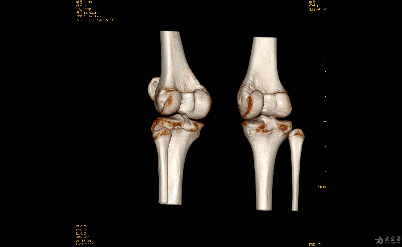 膝关节ct三维重建图片图片