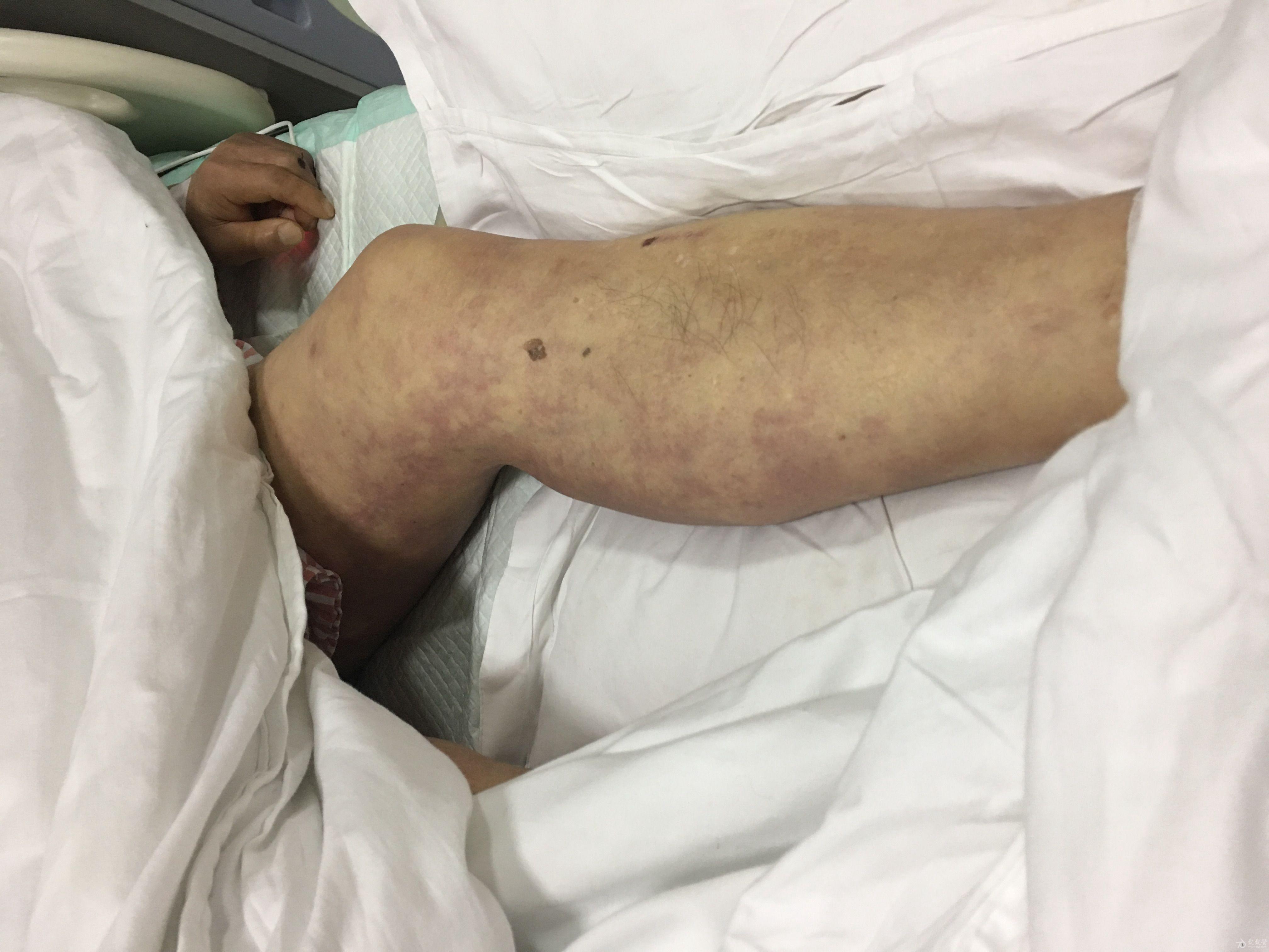 弥漫性血管内凝血(dic)影像一观(原创)