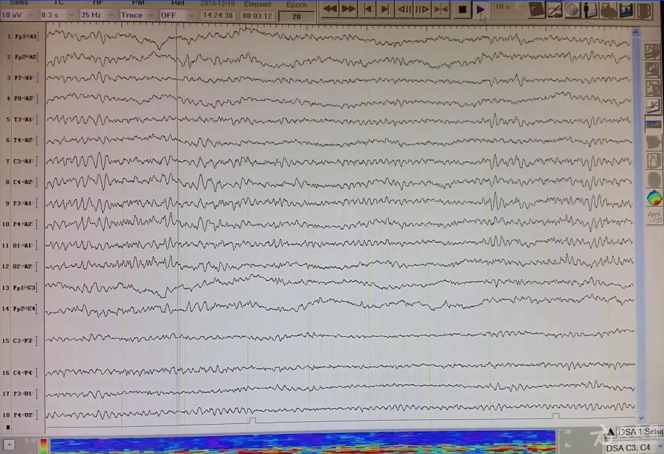 新人脑电图异常请大神帮忙解读