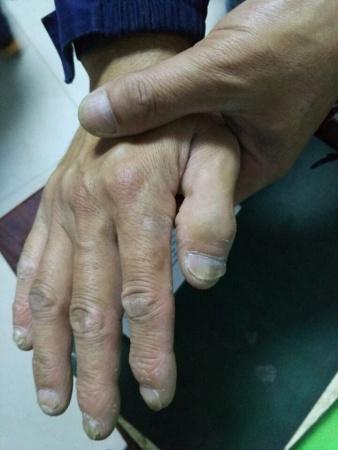 看图诊断 角化过度症 全科医疗专业讨论版 爱爱医医学论坛