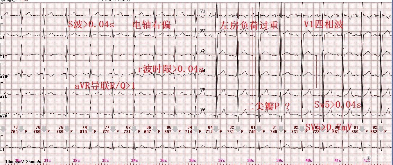 这份心电图诊断什么