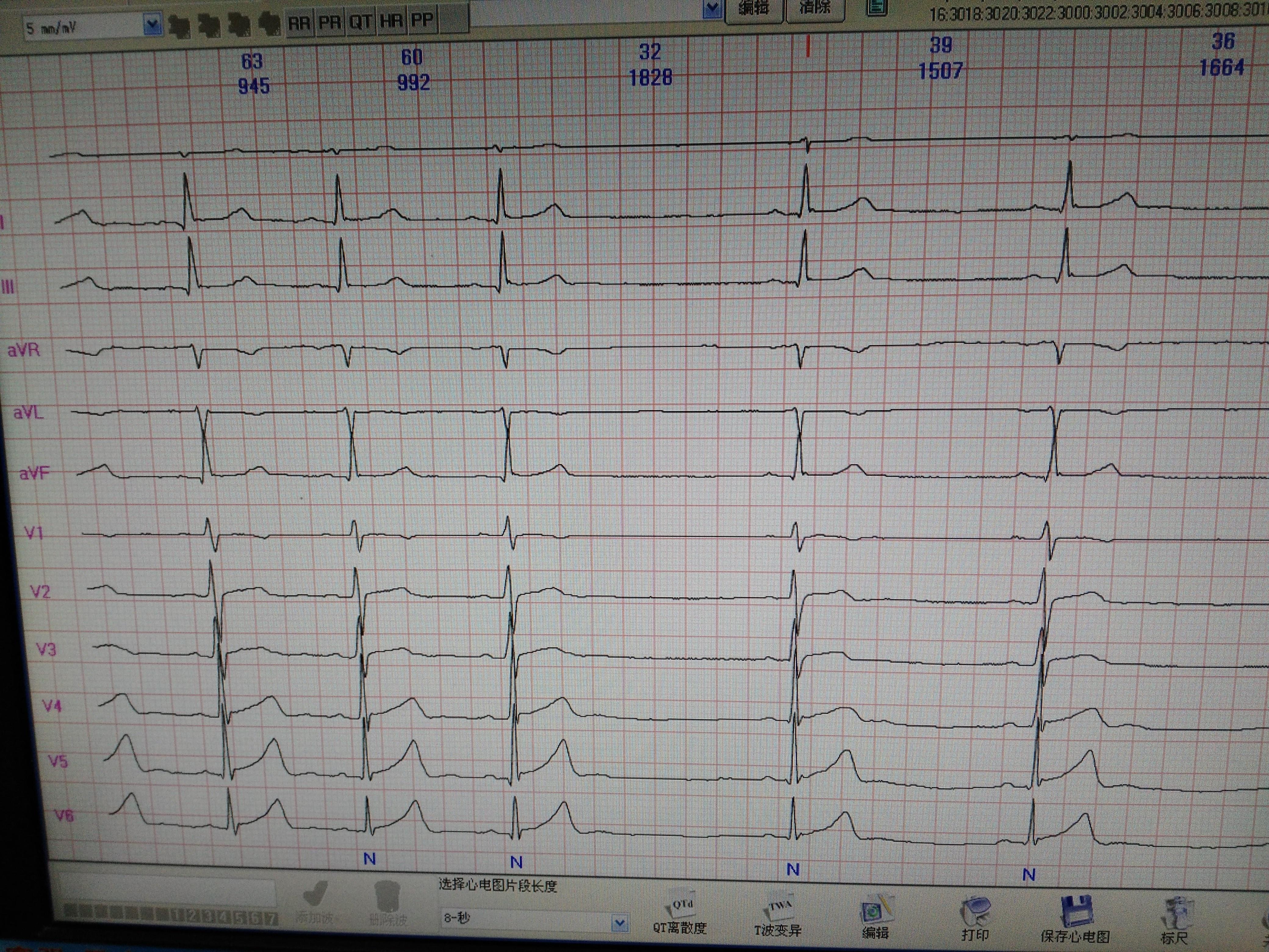 动态心电图诊断qt间期延长的标准