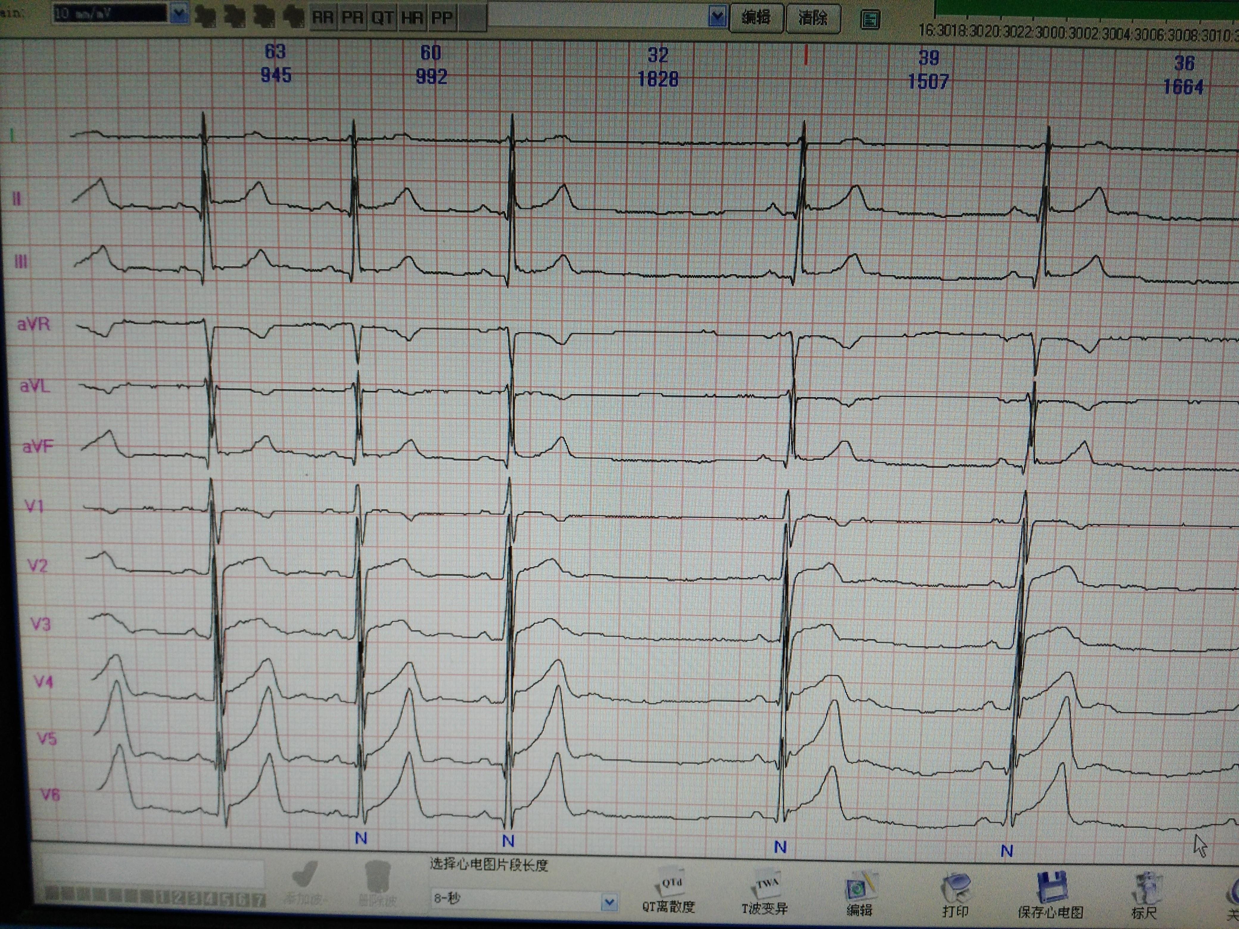 动态心电图诊断qt间期延长的标准