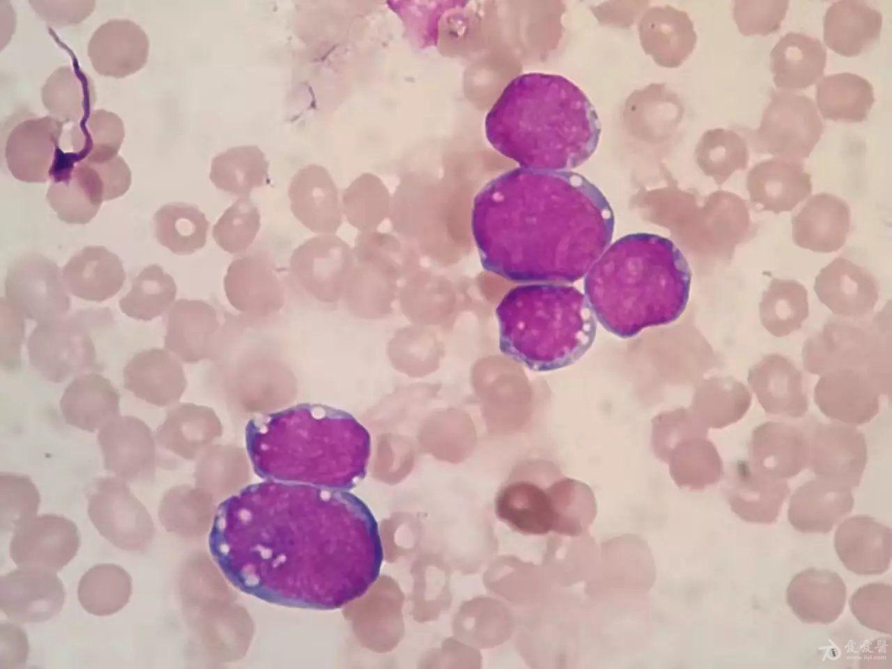 急性淋巴细胞白血病l3图谱