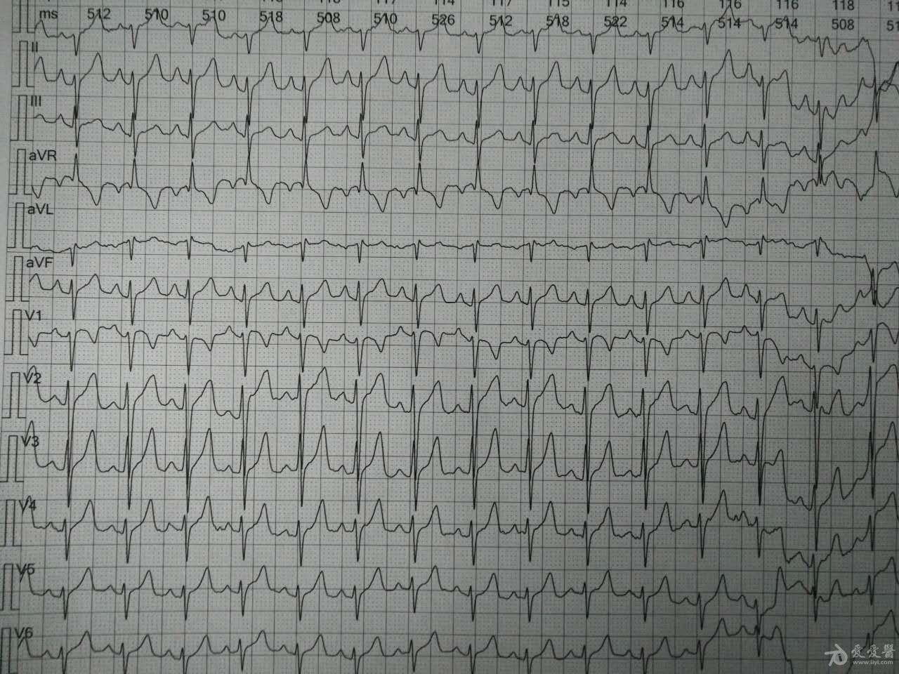 胸导联r波递增不良? - 心电图脑电图专业讨论版 - 爱爱医医学论坛