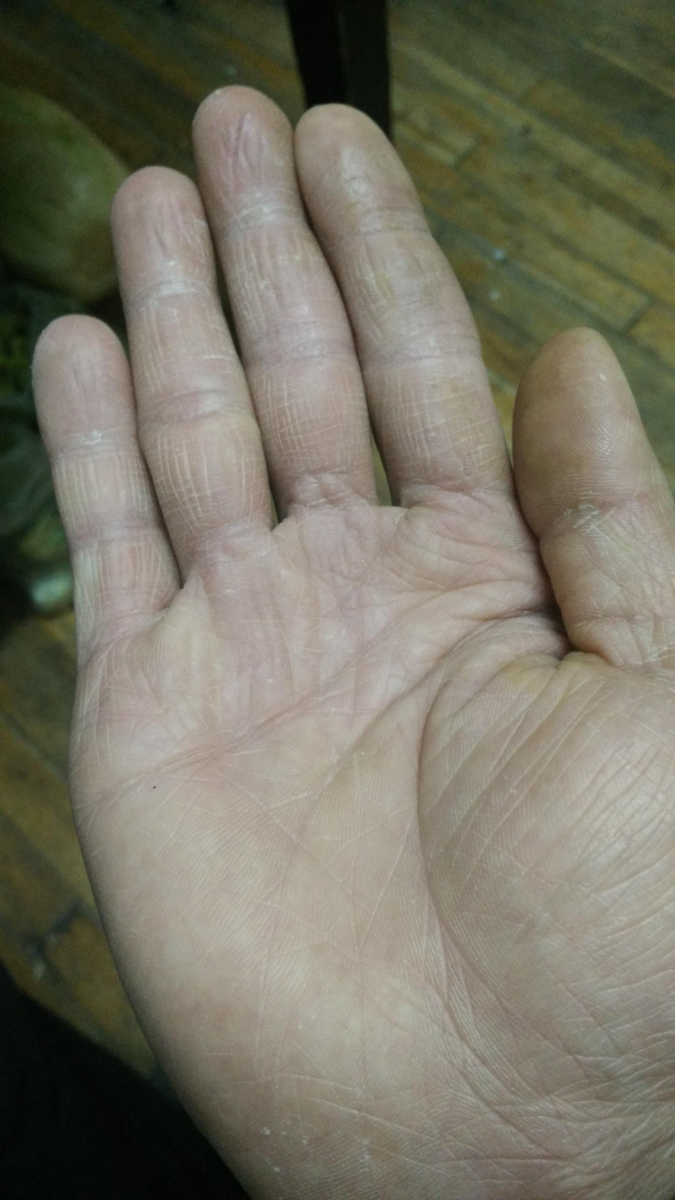 手指头容易干裂.