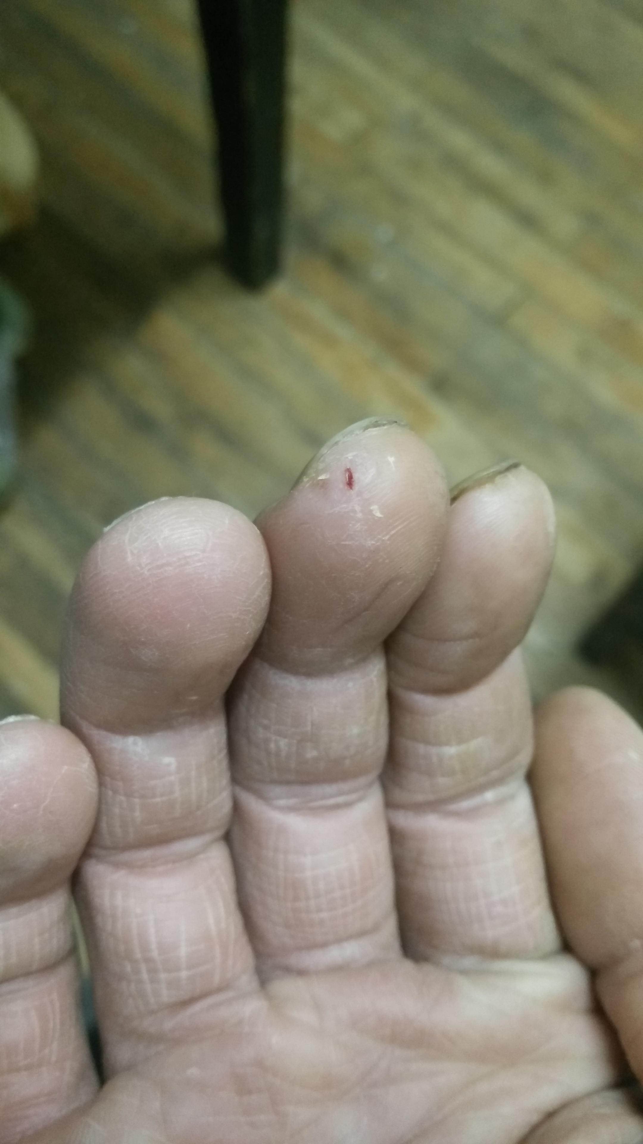 手指头容易干裂.