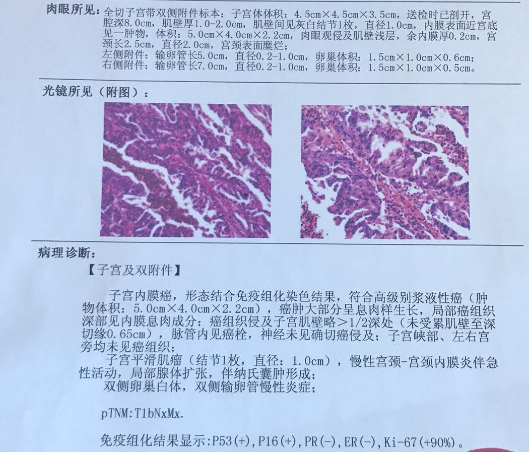 75岁子宫内膜腺癌患者化疗