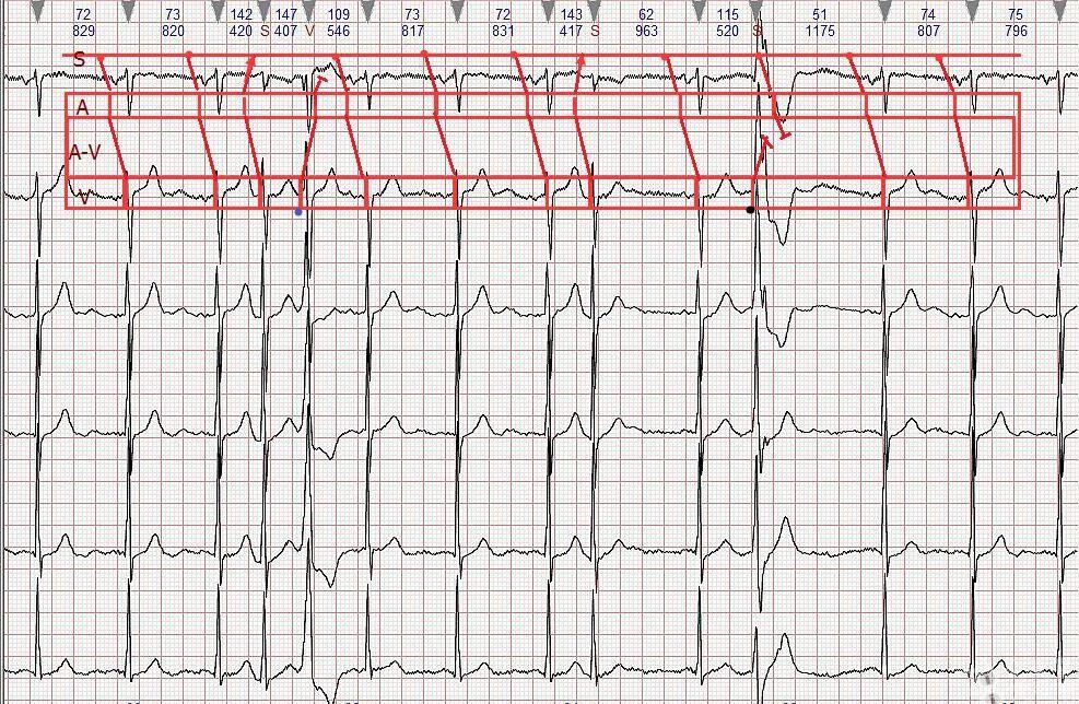 心电图学习20170205早搏分析