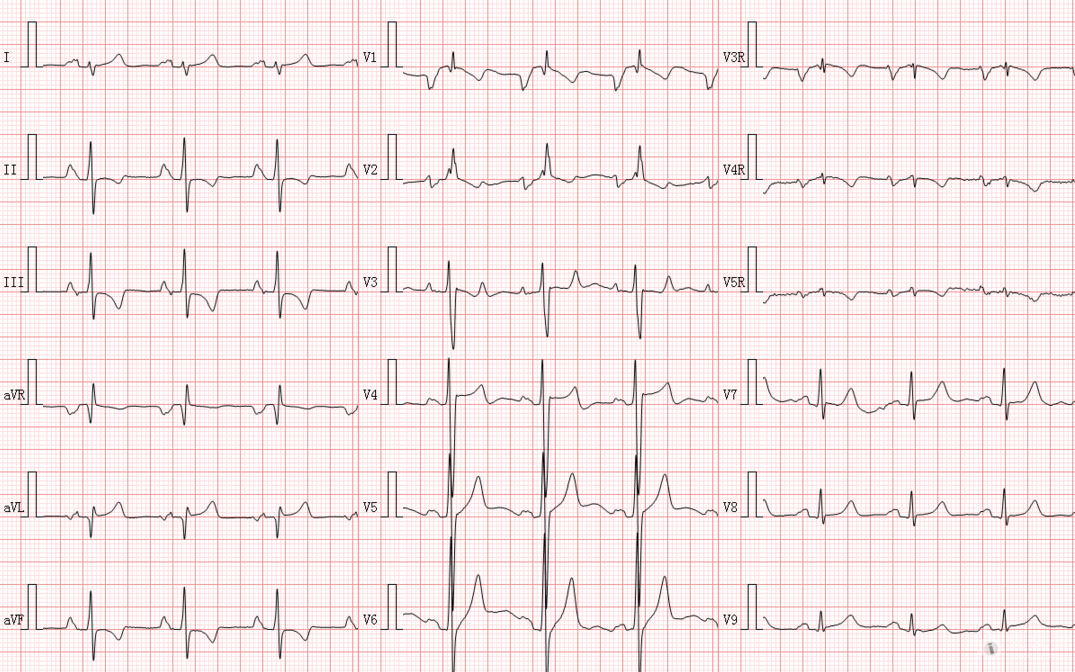 冬秋心电图讨论20170208ptfv1明显增大