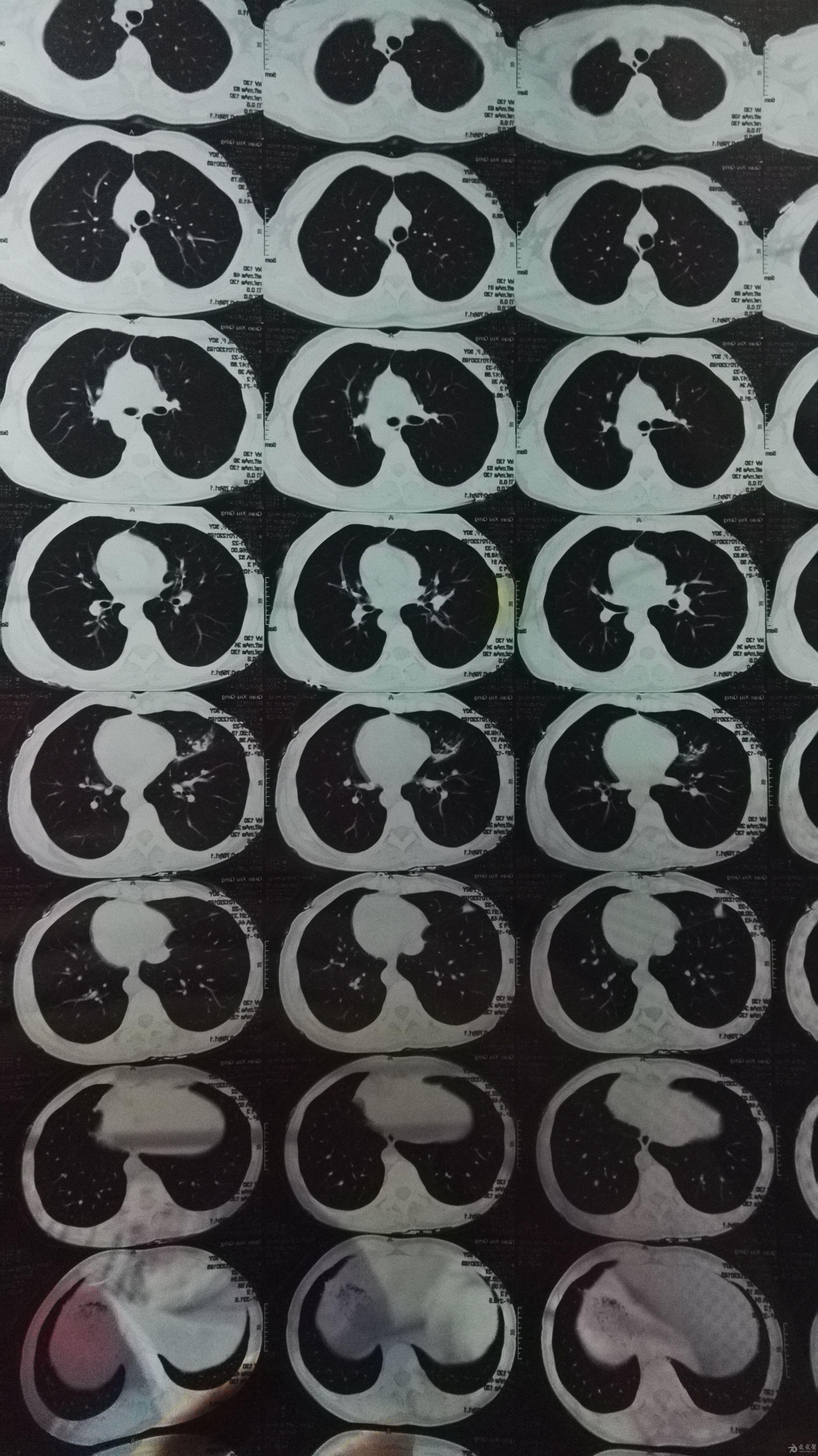 肺部ct诊断