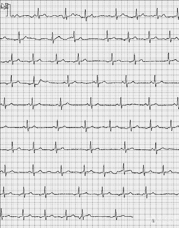 请问这是游走节律吗? - 心电图脑电图专业讨论版 - 爱爱医医学论坛