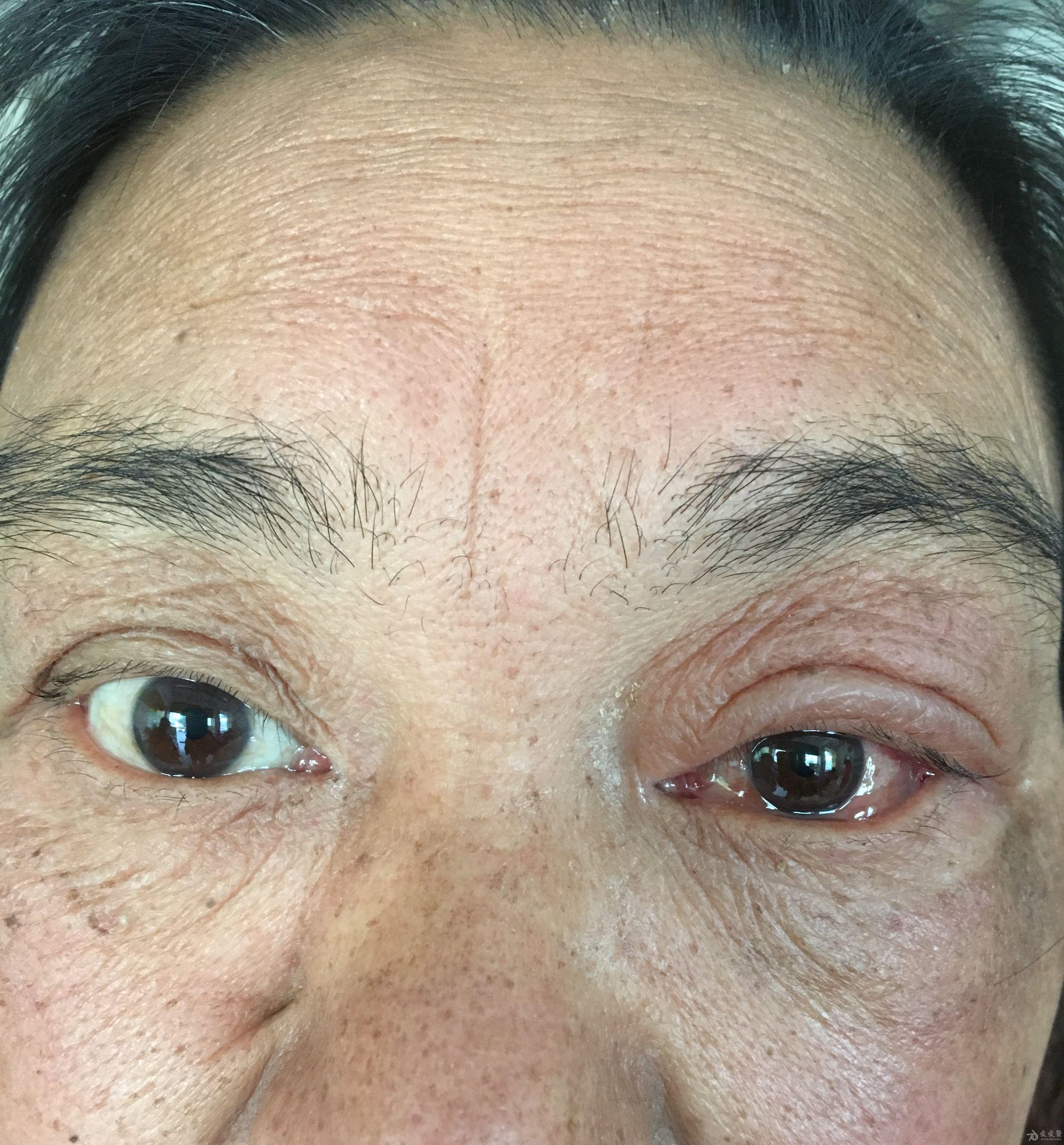 左侧眼部红肿1天
