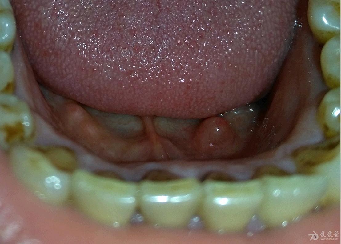 舌腹粘液腺囊肿图片