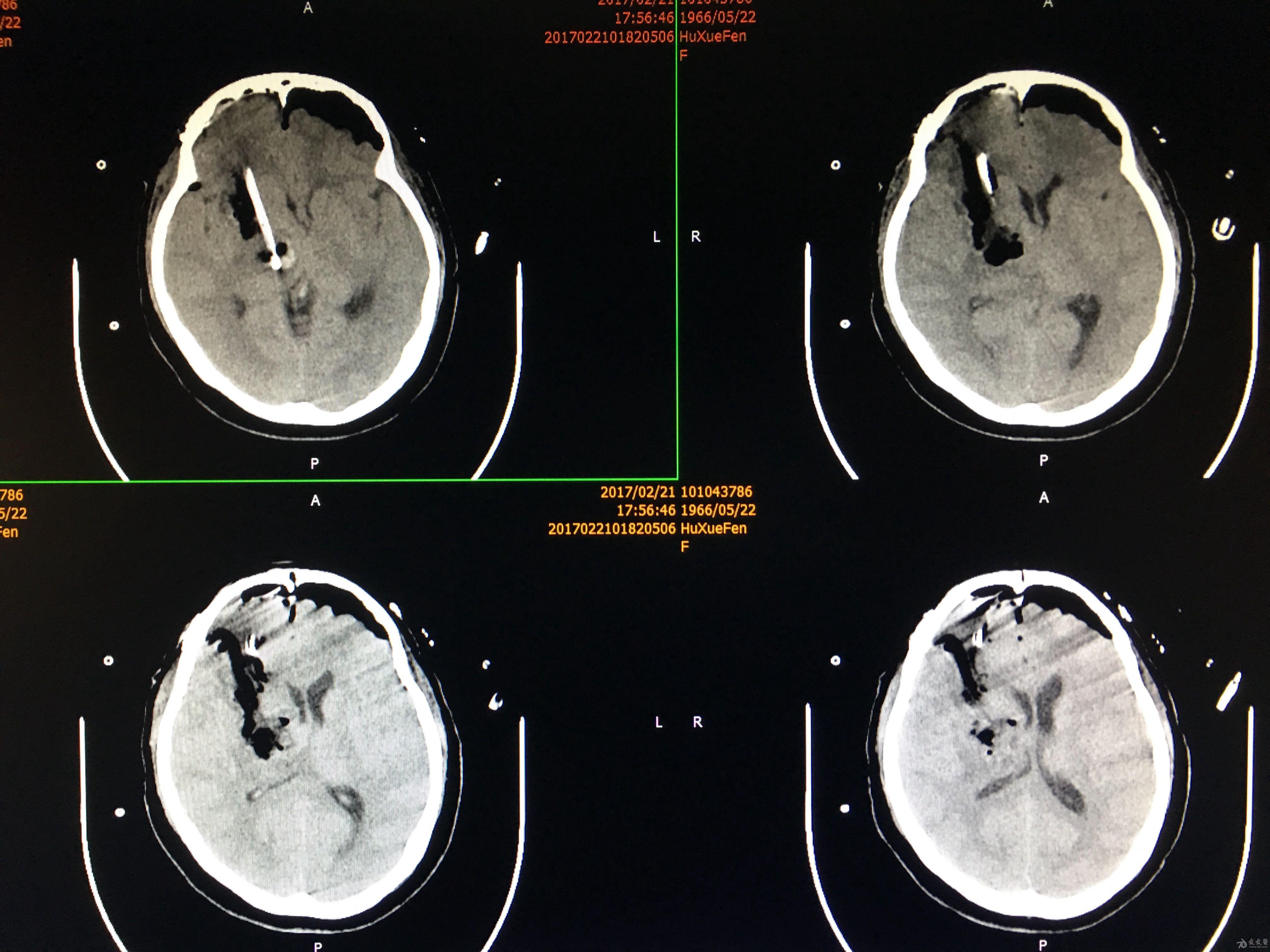 脑脊髓疾病分享一例大脑恶性肿瘤病例原创