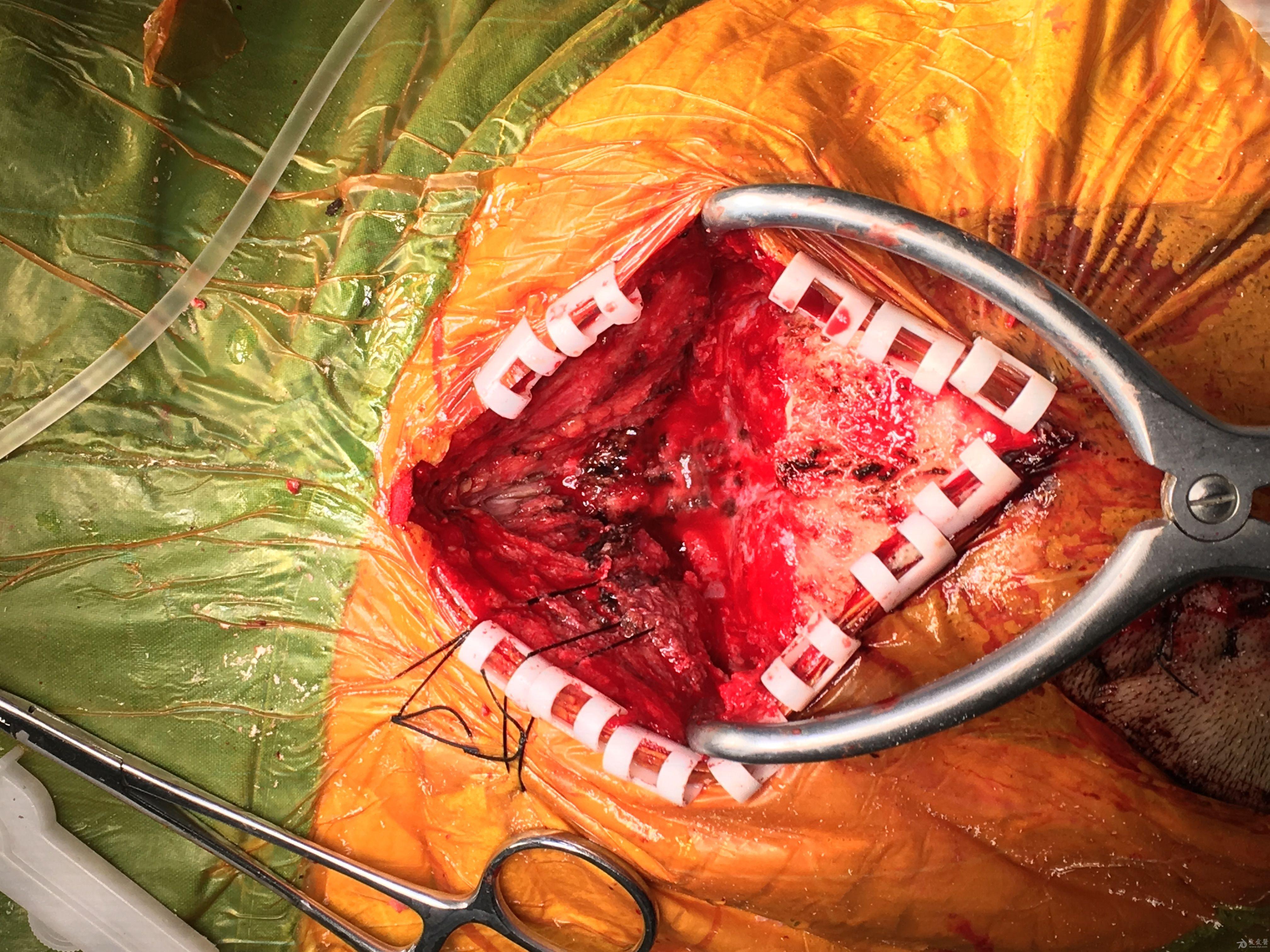 分享小脑肿瘤一例紧贴延髓原创