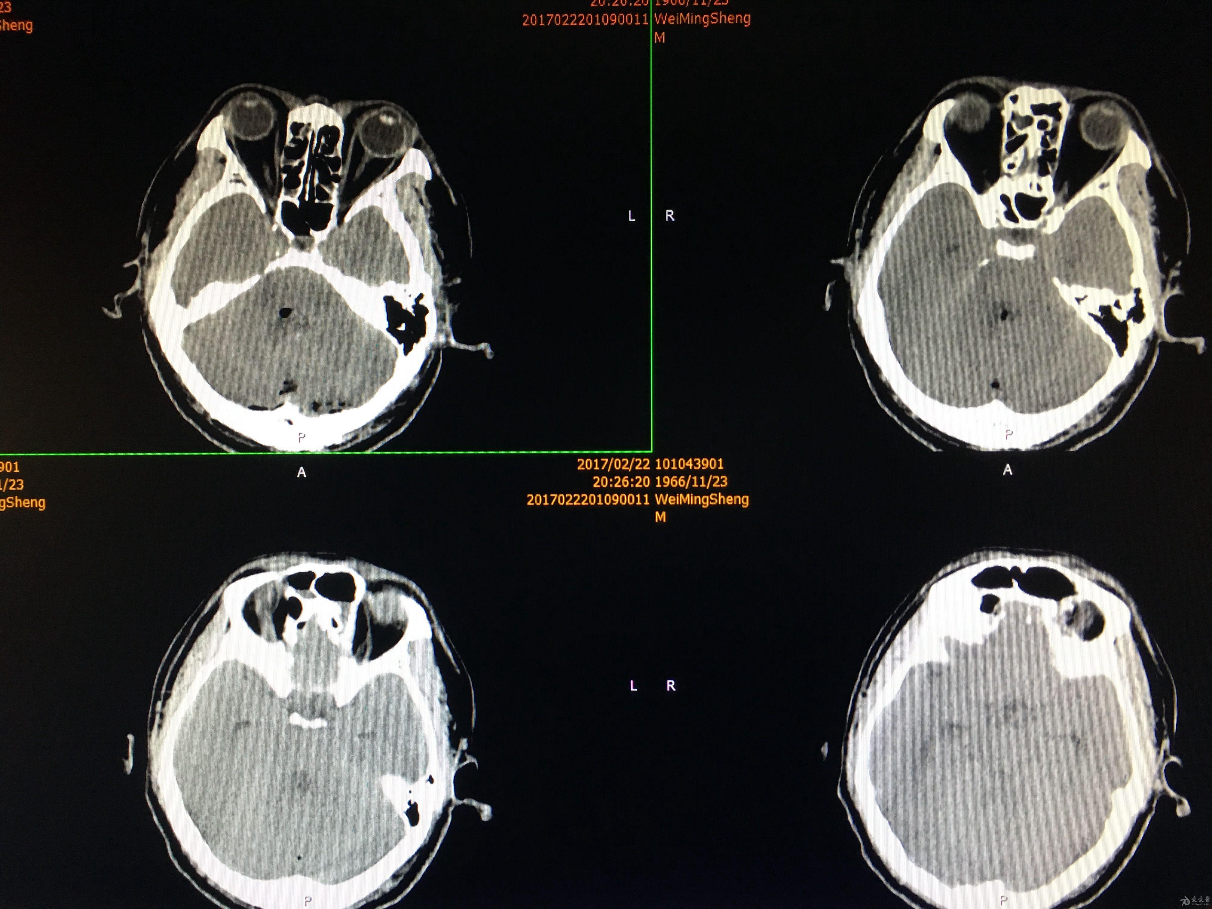 分享小脑肿瘤一例紧贴延髓原创