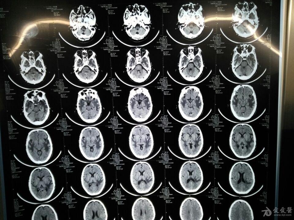 半年前无明显诱因出现吐字不清,右眼模糊,看看片子 - 神经内科讨论版