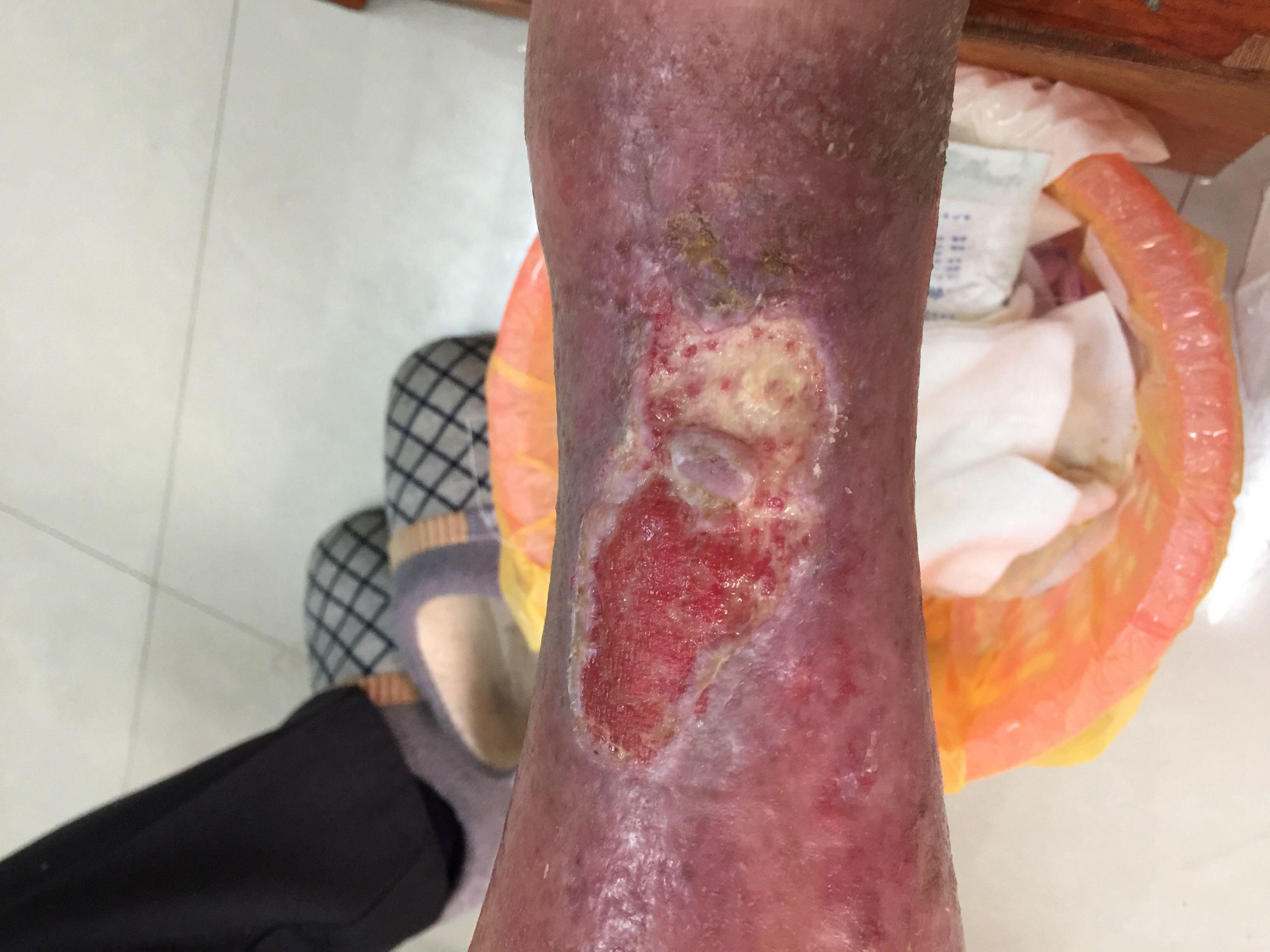 求教各位前辈小腿慢性溃疡的问题 - 皮肤及性传播疾病讨论版 - 爱爱医