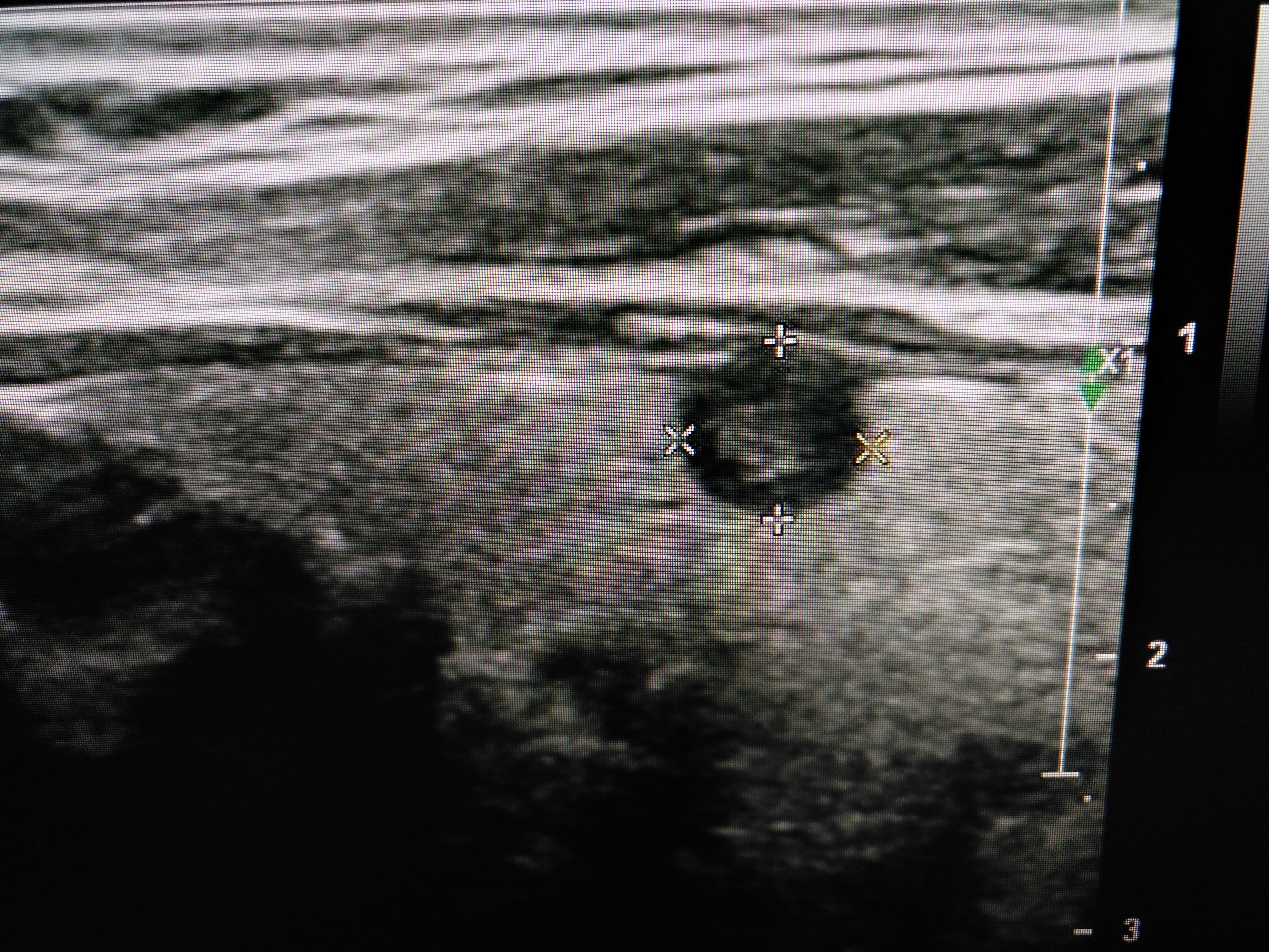 甲状腺结节超声图像图片